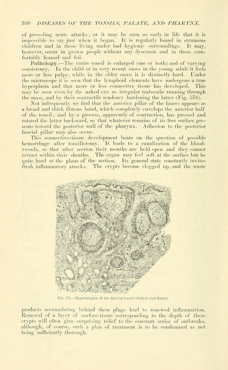 of preceding acute attacks ; or it may be .seen so early in life that it is impossible to say just when it began. It is regularly found in strumous children and in those living under bad hygienic surroundings. It may, however, occur in grown people without any dyscrasia and in those com- fortably housed and fed. Pathology.—The entire tonsil is enlarged (one or both) and of varying consistency. In the child or in very recent cases in the young adult it feels more or less pulpy, while in the older cases it is distinctly hard. Under the microscope it is seen that the lymphoid elements have undergone a true hyperplasia and that more or less connective tissue has developed. This may lie seen even by the naked eye as irregular trabeculse running through the ma>s, and by their contractile tendency hardening the latter (Fig. 57b'). Not infrequently we find that the anterior pillar of the fauces appears as a broad and thick fibrous band, which completely envelops the anterior half of the tonsil ; and by a process, apparently of contraction, has pressed and rotated the latter backward, so that whatever remains of its free surface pre- sents toward the posterior wall of the pharynx. Adhesion to the posterior faucial pillar may also occur. This connective-tissue development bears on the epiestion of possible hemorrhage after tonsillotomy. It leads to a canalization of the blood- vessels, so that after section their mouths arc held open and they cannot retract within their sheaths. The organ may feel soft at the surface but be quite hard at the plane of the section. Its general state constantly invites fresh inflammatory attacks. The crypts become clogged up, and the waste ^ Mm. ■,vr ' w ■ -. . .■'.--. '.' Kig. 57C—Hypertrophy of the faucial tonsil (Seifert and Kahn) products accumulating behind these plugs lead to renewed inflammation. Removal of a layer of surface-tissue corresponding to the depth of these crypts will often give surprising relief to the constant series of outbreaks, although, of course, such a plan of treatment is to be condemned as not being sufficiently thorough.