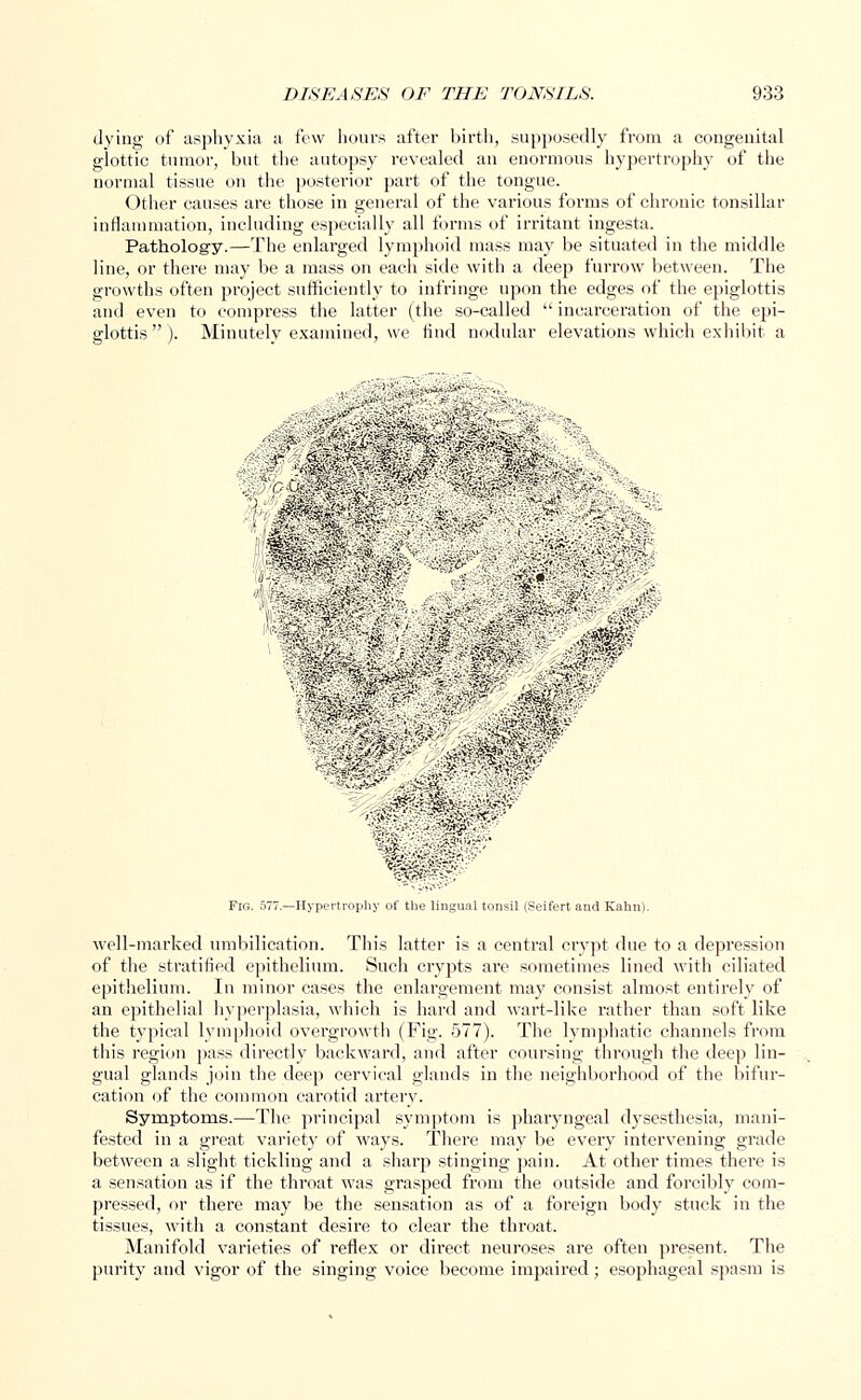 dying of asphyxia a few hours after birth, supposedly from a congenital glottic tumor, but the autopsy revealed an enormous hypertrophy of the normal tissue on the posterior part of the tongue. Other causes are those in general of the various forms of chronic tonsillar inflammation, including especially all forms of irritant ingesta. Pathology.—The enlarged lymphoid mass may be situated in the middle line, or there may be a mass on each side with a deep furrow between. The growths often project sufficiently to infringe upon the edges of the epiglottis and even to compress the latter (the so-called incarceration of the epi- glottis  ). Minutely examined, we find nodular elevations which exhibit a ■■■■* '' ' •*^>-''f.- ' Fig. 577.—Hypertrophy of the lingual tonsil (Seifert and Kahn). well-marked umbilication. This latter is a central crypt due to a depression of the stratified epithelium. Such crypts are sometimes lined with ciliated epithelium. In minor cases the enlargement may consist almost entirely of an epithelial hyperplasia, which is hard and wart-like rather than soft like the typical lymphoid overgrowth (Fig. 577). The lymphatic channels from this region pass directly backward, and after coursing through the deep lin- gual glands join the deep cervical glands in the neighborhood of the bifur- cation of the common carotid artery. Symptoms.—The principal symptom is pharyngeal dysesthesia, mani- fested in a great variety of ways. There may be every intervening grade between a slight tickling and a sharp stinging pain. At other times there is a sensation as if the throat was grasped from the outside and forcibly com- pressed, or there may be the sensation as of a foreign body stuck in the tissues, with a constant desire to clear the throat. Manifold varieties of reflex or direct neuroses are often present. The purity and vigor of the singing voice become impaired; esophageal spasm is