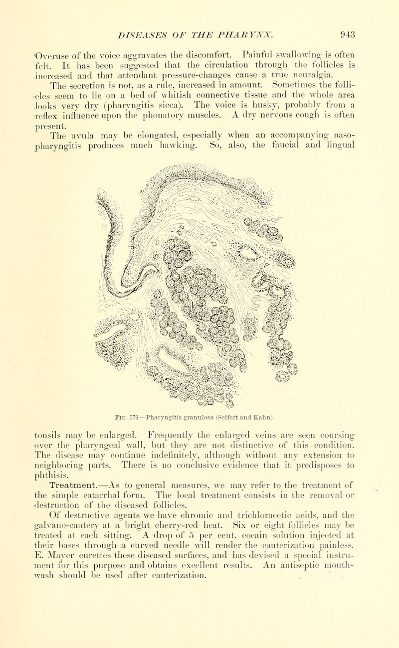 'Overuse of the voice aggravates the discomfort. Painful swallowing is often felt. It has been suggested that the circulation through the follicles is increased and that attendant pressure-changes cause a true neuralgia. The secretion is not, as a rule, increased in amount. Sometimes the folli- •cles seem to lie on a bed of whitish connective tissue and the whole area looks very dry (pharyngitis sicca). The voice is husky, probably from a reflex influence upon the phonatory muscles. A dry nervous cough is often present. The uvula may be elongated, especially when an accompanying naso- pharyngitis produces much hawking. So, also, the faucial and lingual ^•» tmmi ::<rS.' (iiv ■ '?'A . ^-4 i >v'jV -' ;i':yf r-) • HH {^■^. Ids ::: ■'■■:. ,.'■. Fig. 579.—Pharyngitis granulosa (Seifert and Kahn). tonsils may be enlarged. Frequently the enlarged veins are seen coursing over the pharyngeal wall, but they are not distinctive of this condition. The disease may continue indefinitely, although without any extension to neighboring parts. There is no conclusive evidence that it predisposes to phthisis. Treatment.—As to general measures, we may refer to the treatment of the simple catarrhal form. The local treatment consists in the removal or destruction of the diseased follicles. Of destructive agents we have chromic and trichloracetic acids, and the galvano-cautery at a bright cherry-red heat. Six or eight follicles may be treated at each sitting. A drop of 5 per cent, cocain solution injected at their bases through a curved needle will render the cauterization painless. E. Mayer curettes these diseased surfaces, and has devised a special instru- ment for this purpose and obtains excellent results. An antiseptic mouth- wash should be used after cauterization.