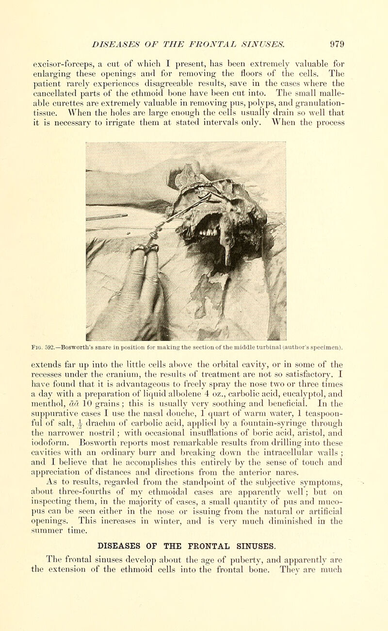 excisor-forceps, a cut of which I present, has been extremely valuable for enlarging these openings and for removing the floors of the cells. The patient rarely experiences disagreeable results, save in the cases where the cancellated parts of the ethmoid bone have been cut into. The small malle- able curettes are extremely valuable in removing pus, polyps, and granulation- tissue. When the holes are large enough the cells usually drain so well that it is necessary to irrigate them at stated intervals only. When the process Fig. 592.—BoswoTth's snare inpositi lie turbinal (author's specimen) extends far up into the little cells above the orbital cavity, or in some of the recesses under the cranium, the results of treatment are not so satisfactory. I have found that it is advantageous to freely spray the nose two or three times a day with a preparation of liquid albolene 4 oz., carbolic acid, eucalyptol, and menthol, act 10 grains; this is usually very soothing and beneficial. In the suppurative cases I use the nasal douche, 1 quart of warm water, 1 teaspoon- ful of salt, J drachm of carbolic acid, applied by a fountain-syringe through the narrower nostril; with occasional insufflations of boric acid, aristol, and iodoform. Bosworth reports most remarkable results from drilling into these cavities with an ordinary burr and breaking down the intracellular wails ; and I believe that he accomplishes this entirely by the sense of touch and appreciation of distances and directions from the anterior nares. As to results, regarded from the standpoint of the subjective symptoms, about three-fourths of my ethmoidal cases are apparently well; but on inspecting them, in the majority of cases, a small quantity of pus and muco- pus can be seen either in the nose or issuing from the natural or artificial openings. This increases in winter, and is very much diminished in the summer time. DISEASES OF THE FRONTAL SINUSES. The frontal sinuses develop about the age of puberty, and apparently are the extension of the ethmoid cells into the frontal bone. Thev are much