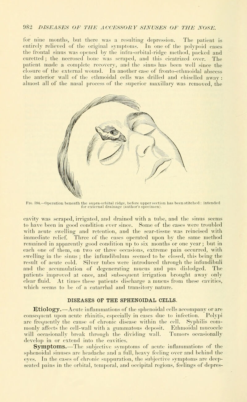 for nine months, but there was a resulting' depression. The patient is entirely relieved of the original symptoms. In one of the polypoid eases the frontal sinus was opened by the infra-orbital-ridge method, packed and curetted; the necrosed bone was scraped, and tins cicatrized over. The patient made a complete recovery, and the sinus has been well since the closure of the external wound. In another case of fronto-ethmoidal abscess the anterior wall of the ethmoidal cells was drilled and chiselled away : almost all of the nasal process of the superior maxillary was removed, the Fig. 594.—Operation beneath the supra-orbital ridge, before upper section has been stitched : intended for externa] drainage (author's specimen). cavity was scraped, irrigated, and drained with a tube, and the sinus seems to have been in good condition ever since. Some of the cases were troubled with acute swelling and retention, and the scar-tissue was reincised with immediate relief. Three of the cases operated upon by the same method remained in apparently good condition up to six months or one year; but in each one of them, on two or three occasions, extreme pain occurred, with swelling in the sinus ; the infundibulum seemed to be closed, this being the result of acute cold. Silver tubes were introduced through the infundibuli and the accumulation of degenerating mucus and pus dislodged. The patients improved at once, and subsequent irrigation brought away only clear fluid. At times these patients discharge a mucus from these cavities, which seems to be of a catarrhal and transitory nature. DISEASES OF THE SPHENOIDAL CELLS. Etiology.—Acute inflammations of the sphenoidal cells accompany or are consequent upon acute rhinitis, especially in cases due to infection. Polypi are frequently the cause of chronic disease within the cell. Syphilis com- monly affects the cell-wall with a gummatous deposit. Ethmoidal mucocele will occasionally break through the dividing wall. Tumors occasionally develop in or extend into the cavities. Symptoms.—The subjective symptoms of acute inflammations of the sphenoidal sinuses are headache and a full, heavy feeling over and behind the eves. In the cases of chronic suppuration, the subjective symptoms are deep- seated pains in the orbital, temporal, and occipital regions, feelings of depres-