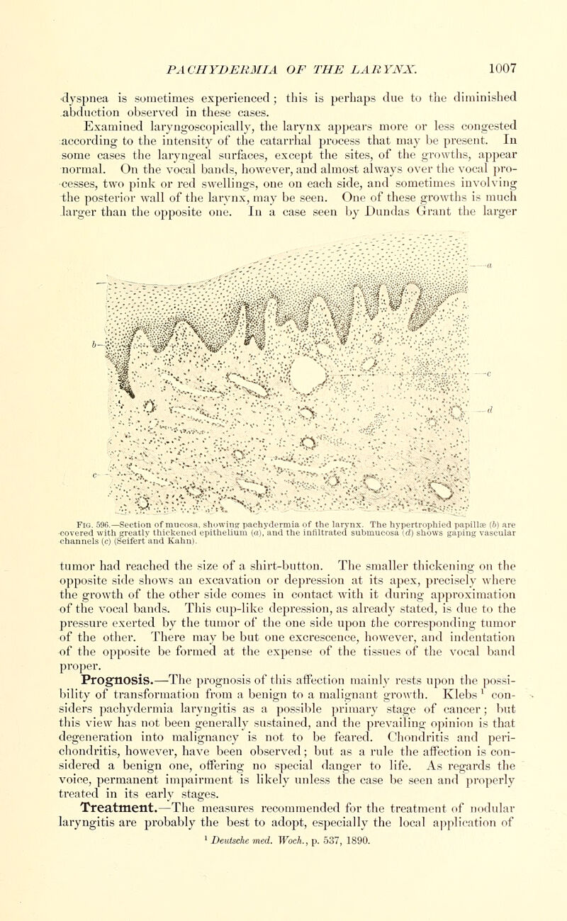 dyspnea is sometimes experienced ; this is perhaps due to the diminished abduction observed in these cases. Examined laryngoscopically, the larynx appears more or less congested according to the intensity of the catarrhal process that may be present. In some cases the laryngeal surfaces, except the sites, of the growths, appear normal. On the vocal bands, however, and almost always over the vocal pro- cesses, two pink or red swellings, one on each side, and sometimes involving the posterior wall of the larynx, may be seen. One of these growths is much larger than the opposite one. In a case seen by Dundas Grant the larger ' o i \,  | ; § < ' .1 V *' . V* . ■ : ■ ,.1 '■■■■ ; ■ ■ ' ■- - 5 ** .; -'•.■••- '.' O-- -' - ' ' '-.'..•• •. •■•V**-.'' ■;■:• ■-.. V -■■■■■■<■■■ T-. ,.'•;■■ .- - , .-', \M • '.•'- -.• •'. i,' \t$-■:.■ . ' *lpvj •• . . .-•.•■' , ' . .rvJ .' '■■'X ■ '' ■ 'J *-X • ,i . .-': ,, : .;■ -i ; -, \ Fig. 596.—Section of mucosa, showing pachydermia of the larynx. The nypertrophied papillae (b) are covered with greatly thickened epithelium (a), and the infiltrated submucosa (d) shows gaping vascular channels (c) (Seifert'and Kahn). tumor had reached the size of a shirt-button. The smaller thickening on the opposite side shows an excavation or depression at its apex, precisely where the growth of the other side comes in contact with it during approximation of the vocal bands. This cup-like depression, as already stated, is due to the pressure exerted by the tumor of the one side upon the corresponding tumor of the other. There may be but one excrescence, however, and indentation of the opposite be formed at the expense of the tissues of the vocal band proper. Prognosis.—-The prognosis of this affection mainly rests upon the possi- bility of transformation from a benign to a malignant growth. Klebs ' con- siders pachydermia laryngitis as a possible primary stage of cancer; but this view has not been generally sustained, and the prevailing opinion is that degeneration into malignancy is not to be feared. Chondritis and peri- chondritis, however, have been observed; but as a rule the affection is con- sidered a benign one, offering no special danger to life. As regards the voice, permanent impairment is likely unless the case be seen and properly treated in its early stages. Treatment.—The measures recommended for the treatment of nodular laryngitis are probably the best to adopt, especially the local application of 1 Deutsche med. Woch., p. 537, 1890.