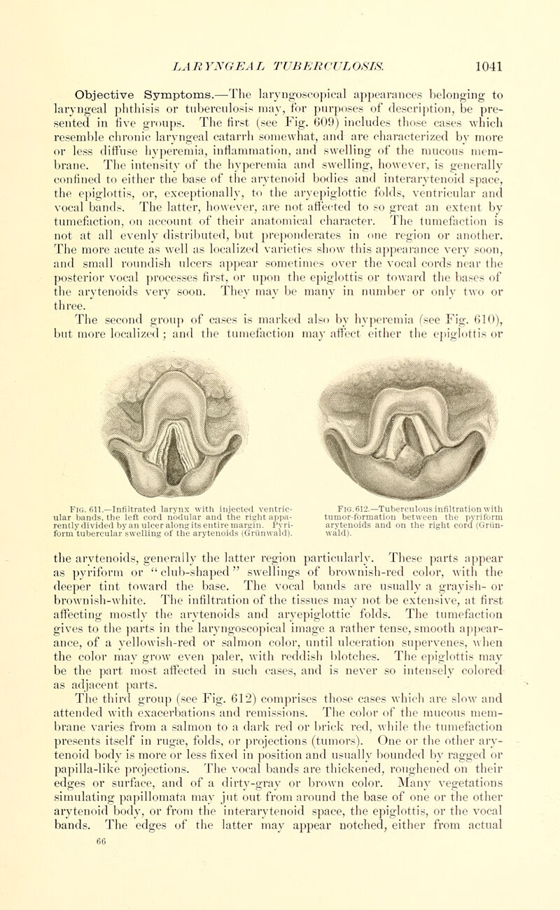 Objective Symptoms.—The laryngoscopical appearances belonging to laryngeal phthisis or tuberculosis may, for purposes of description, be pre- sented in five groups. The first (see Fig. 609) includes those cases which resemble chronic laryngeal catarrh somewhat, and are characterized by more or less diffuse hyperemia, inflammation, and swelling of the mucous mem- brane. The intensity of the hyperemia and swelling, however, is generally confined to either the base of the arytenoid bodies and interarytenoid space, the epiglottis, or, exceptionally, to the aryepiglottic folds, ventricular and vocal bands. The latter, however, are not affected to so great an extent by tumefaction, on account of their anatomical character. The tumefaction is not at all evenly distributed, but preponderates in one region or another. The more acute as well as localized varieties show this appearance very soon, and small roundish ulcers appear .sometimes over the vocal cords near the posterior vocal processes first, or upon the epiglottis or toward the bases of the arytenoids very soon. They may be many in number or only two or three. The second group of cases is marked also by hyperemia (see Fig. 610), but more localized ; and the tumefaction may affect either the epiglottis or Fig. 611—Infiltrated larynx with injected ventric- ular bands, the left cord nodular and the rightappa- rently divided bv an ulcer along its entire margin. Pyri- form tubercular swelling of the arytenoids (GrQnwald). Fig.612.—Tuberculous infiltration with tumor-formation between the pyriform arytenoids and on the right cord (Grun- wald). the arytenoids, generally the latter region particularly. These parts appear as pyriform or  club-shaped swellings of brownish-red color, with the deeper tint toward the base. The vocal bands are usually a grayish- or brownish-white. The infiltration of the tissues may not be extensive, at first affecting mostly the arytenoids and aryepiglottic folds. The tumefaction gives to the parts in the laryngoscopical image a rather tense, smooth appear- ance, of a yellowish-red or salmon color, until ulceration supervenes, when the color may grow even paler, with reddish blotches. The epiglottis may be the part most affected in such cases, and is never so intensely colored as adjacent parts. The third group (see Fig. 612) comprises those cases which are slow and attended with exacerbations and remissions. The color of the mucous mem- brane varies from a salmon to a dark red or brick red, while the tumefaction presents itself in ruga?, folds, or projections (tumors). One or the other ary- tenoid body is more or less fixed in position and usually bounded by ragged or papilla-like projections. The vocal bands are thickened, roughened on their edges or surface, and of a dirty-gray or brown color. Many vegetations jut out from around the base of one or the other interarytenoid space, the epiglottis, or the vocal latter may appear notched, either from actual simulating papillomata may arytenoid body, or from the bands. The edges of the