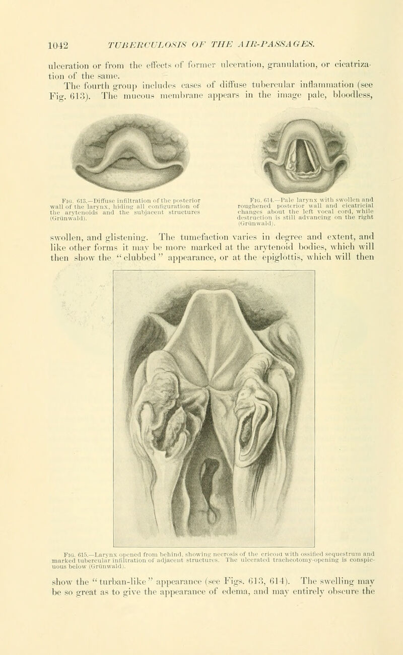 ulceration or from the effects of former ulceration, granulation, or cicatriza- tion f the same. The fourth group includes rases of diffuse tubercular inflammation (see Fig. 613). The mucous membrane appears in the image pale, bloodless, Fig. 613.—Diffuse infiltration ofthe posterior \v:ill of the larynx, hiding all configuration f the arytenoids and the subjaeenl structures (Griinwald). Fig. 614.—Pale larynx with swollen and roughened posterior wall and cicatricial changes about the left vocal cord, while destruction is still advancing on the right '. runwaldj. swollen, and glistening. The tumefaction varies in degree and extent, and like other forms it may be more marked at the arytenoid bodies, which will then show the clubbed appearance, or at the epiglottis, whieh will then Fig. 615.—Larynx opened from behind, showing nrrnisis <■! the rrirnin with .issiiicd sequestrum and marked tubercular infiltration oi adjacent structures. The ulcerated tracheotomy-opening is conspic- uous below (Griinwald show the turban-like appearance (see Figs. 613, 614). The swelling may be so great as to give the appearance of edema, and may entirely obscure the