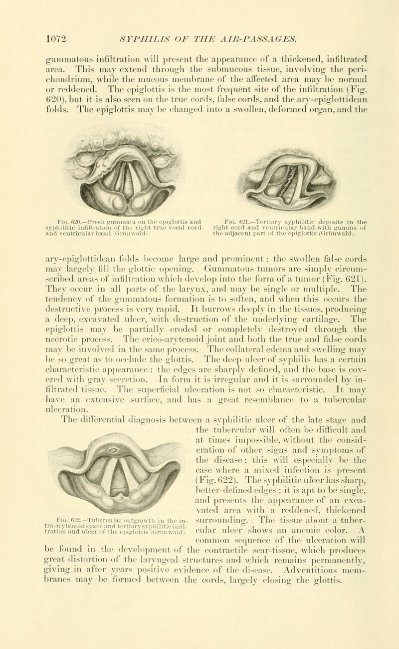 gummatous infiltration will present the appearance of a thickened, infiltrated area. This may extend through the submucous tissue, involving the peri- chondrium, while the mucous membrane of the affected area may be normal or reddened. The epiglottis is the most frequent site of the infiltration (Fig. 620), but it is also seen on the true cords, false cords, and the ary-epiglottidean folds. The epiglottis may be changed into a swollen, deformed organ, and the Fig. 620.—Fresh gummata on the epiglottis and syphilitic infiltration of the right true vocal cord and ventricular band (Griinwald). Fig. 621.—Tertiary syphilitic deposits in the riylit cord and ventricular b.tnil with LOlmina of the adjacent part of the epiglottis (Griinwald). ary-epiglottidean folds become large and prominent : the swollen false cords may largely till the glottic opening. Gummatous tumors are simply circum- scribed areas of infiltration which develop into the form of a tumor (Fig. 621). They occur in all parts of the larynx, and may be single or multiple. The tendency of the gummatous formation is to soften, and when this occurs the destructive process is very rapid. It burrows deeply in the tissues, producing a deep, excavated ulcer, with destruction of the underlying cartilage. The epiglottis may be partially eroded or completely destroyed through the necrotic process. The crico-arytenoid joint and both the true and false cords may be involved in the same process. The collateral edema and swelling may be so great as to occlude the glottis. The deep ulcer of syphilis has a certain characteristic appearance : the edges are sharply defined, and the base is cov- ered with gray secretion. In form it is irregular and it is surrounded by in- filtrated tissue. The superficial ulceration is not so characteristic. It may have an extensive surface, and has a great resemblance to a tubercular ulceration. The differential diagnosis between a syphilitic ulcer of the late stage and the tubercular will often be difficult and at times impossible, without the consid- eration of other signs and symptoms of the disease; this will especially lie the case where a mixed infection is present ( Fig. 622). Tin' syphilitic ulcer has sharp, better-defined edges ; it is apt to be single, and presents the appearance of an exca- vated area with a reddened, thickened surrounding. The tissue about a tuber- cular ulcer shows an anemic color. A common sequence of the ulceration will be found in the development of the contractile sear-tissue, which produces great distortion of the laryngeal structures and which remains permanently, giving in after years positive evidence of the disease. Adventitious mem- branes may be formed between the cords, largely closing the glottis. 1 ig. 622. -Tubercular outgrowth in the in- tra-arytenoid space and tertiary syphilitic in ni- tration and ulcer of the epiglottis lOriinwaldi