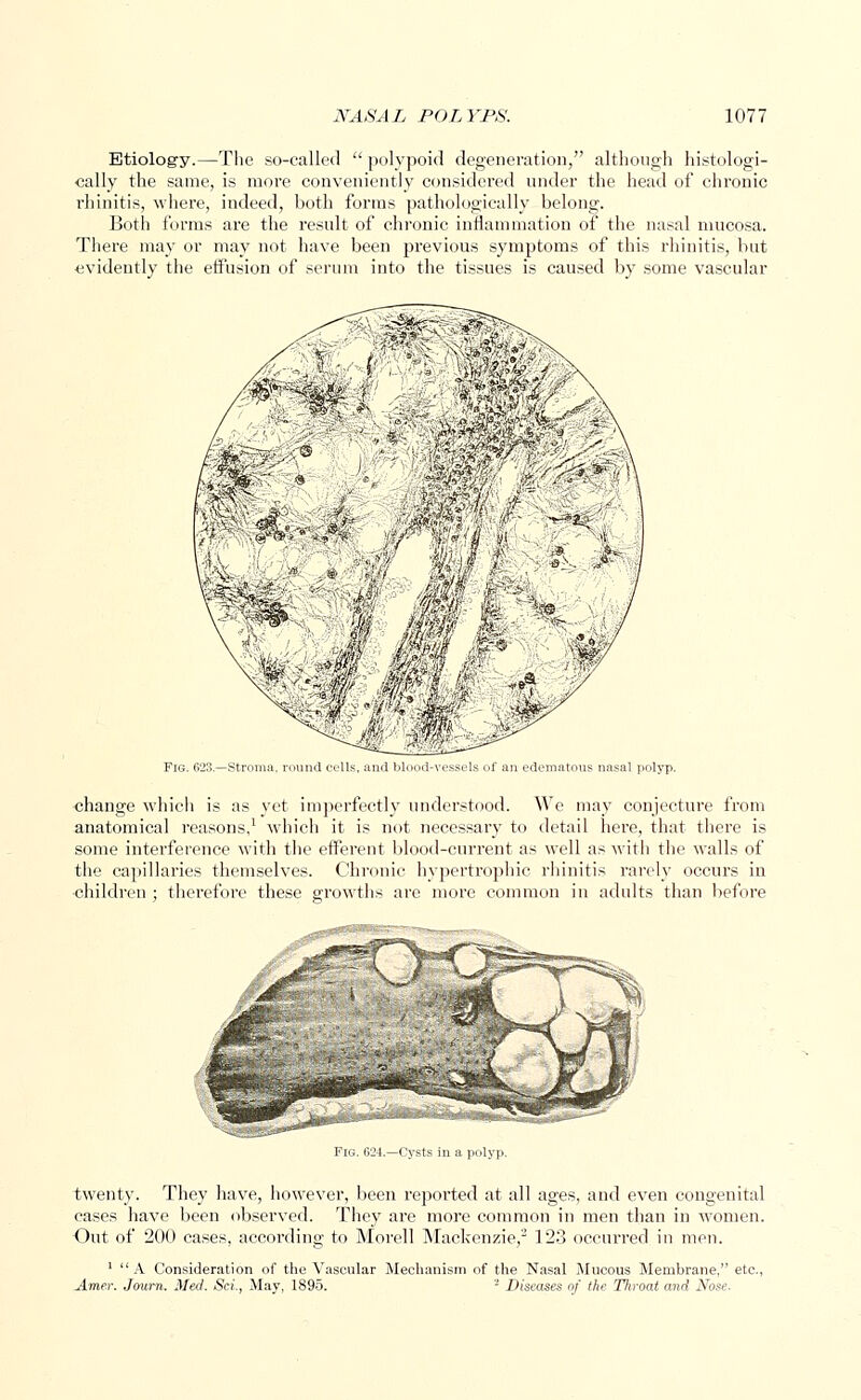 Etiology.—The so-called  polypoid degeneration, although histologi- cally the same, is more conveniently considered under the head of chronic rhinitis, where, indeed, both forms pathologically belong. Both forms are the result of chronic inflammation of the nasal mucosa. There may or may not have been previous symptoms of this rhinitis, but evidently the effusion of serum into the tissues is caused by some vascular Fig. 623.—Stroma, round colls, and blood-vessels of an edematous nasal polyp. change which is as yet imperfectly understood. We may conjecture from anatomical reasons,1 which it is not necessary to detail here, that there is some interference with the efferent blood-current as well as with the walls of the capillaries themselves. Chronic hypertrophic rhinitis rarely occurs in children ; therefore these growths are more common in adults than before Fig. 624.—Cysts in a polyp. twenty. They have, however, been reported at all ages, and even congenital cases have been observed. They are more common in men than in women. Out of 200 cases, according to Morell Mackenzie,3 123 occurred in men. 1 A Consideration of the Vascular Mechanism of the Nasal Mucous Membrane, etc., Ame.r. Journ. Med. Sci., May, 1895. 2 Diseases of the Throat and Nose.