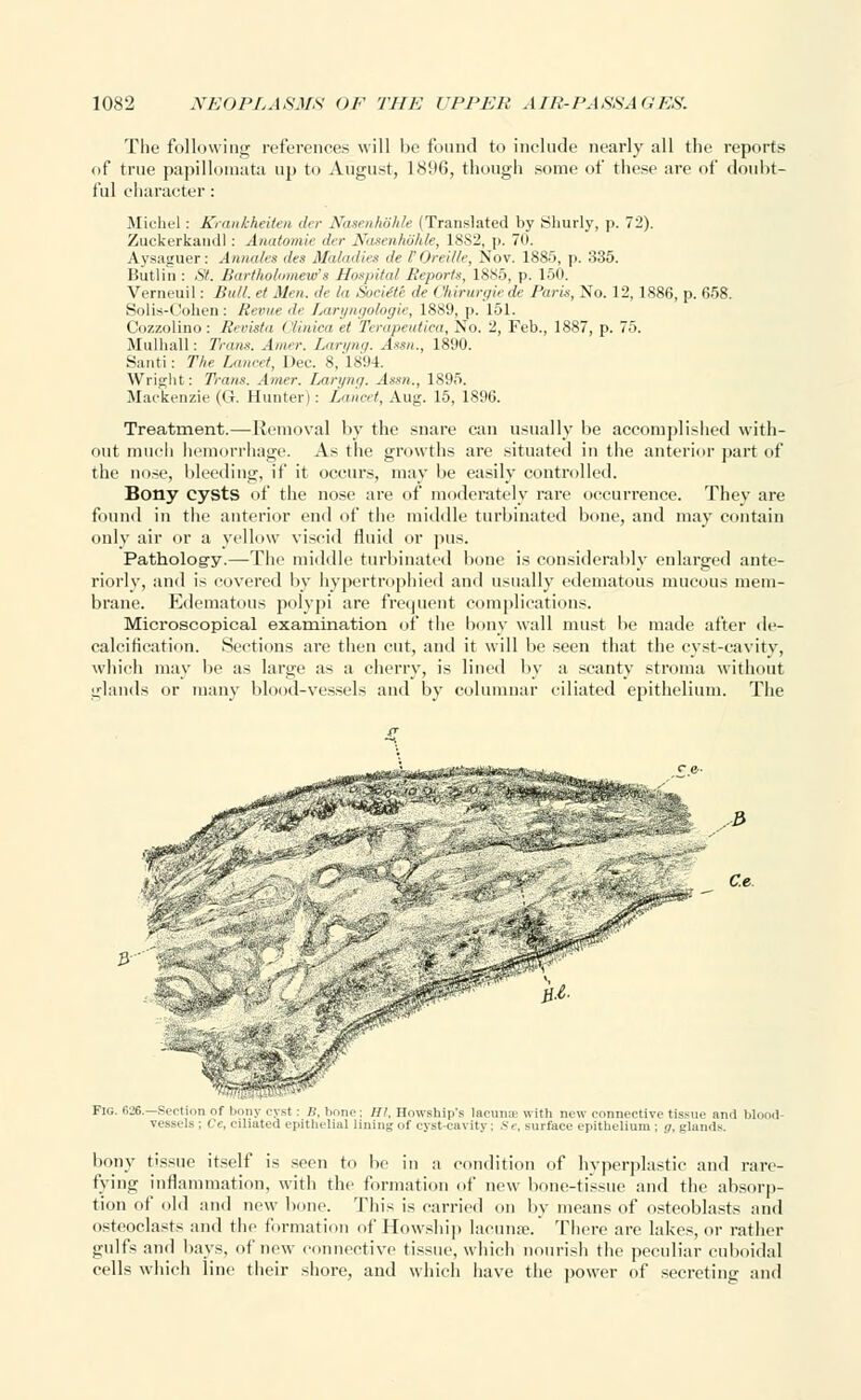 The following references will be found to include nearly all the reports of true papillomata up to August, 1896, though some of these are of doubt- ful character : Michel: Krankheiten der Nasenhohle (Translated by Shurly, p. 72). Zuckerkaudl: Anatomic der Nasenhohle, 18S2, p. To. Aysaguer: Annates des Maladies de VOreille, Nov. 1885, p. 335. Butlin: St. Bartholomew'* Hospital Reports, 1885, p. L50. Vemeuil: Bull, et Men. de la Soctite de ('hirurgiede Paris, No. 12, 1886, p. 658. Solis-Cohen: Revue de Laryngologie, 1889, p. 151. Cozzolino: Revista Oliniea et Terapeutiea,TSo. 2, Feb., 1887, p. 75. Mulhall: Trans. Amer. Laryng. Assn., 1890. Santi: The Lancet, Dec. 8, 1894. Wright: Trans. Amer. Laryng. Assn., 1895. Mackenzie (G. Hunter): Lancet, Aug. 15, 1896. Treatment.—Removal by the snare can usually be accomplished with- out much hemorrhage. As the growths are situated in the anterior part of the nose, bleeding, if it occurs, may be easily controlled. Bony cysts of the nose are of moderately rare occurrence. They are found in the anterior end of the middle turbinated bone, and may contain only air or a yellow viscid fluid or pus. Pathology.—The middle turbinated bone is considerably enlarged ante- riorly, and is covered by hypertrophied and usually edematous mucous mem- brane. Edematous polypi are frequent complications. Microscopical examination of the bony wall must be made after de- calcification. Sections are then cut, and it will be seen that the cyst-cavity, which may be as large as a cherry, is lined by a scanty stroma without glands or many blood-vessels and by columnar ciliated epithelium. The C.e $ Fig. 626.—Suction of bony cyst : B, lionp; HI, Howship's lacuna- with new connective tissue and blood- vessels ; Ce, ciliated epithelial lining of cyst-cavity : Se, surface epithelium ; g, glands. bony tissue itself is seen to be in a condition of hyperplastic and rare- tying inflammation, with the formation of new bone-tissue and the absorp- tion of old and new bone. This is carried on by means of osteoblasts and osteoclasts and the formation of Howship lacunae. There are lakes, or rather gulf's and bays, of new connective tissue, which nourish the peculiar cuboidal cells which line their shore, and which have the power of secreting and