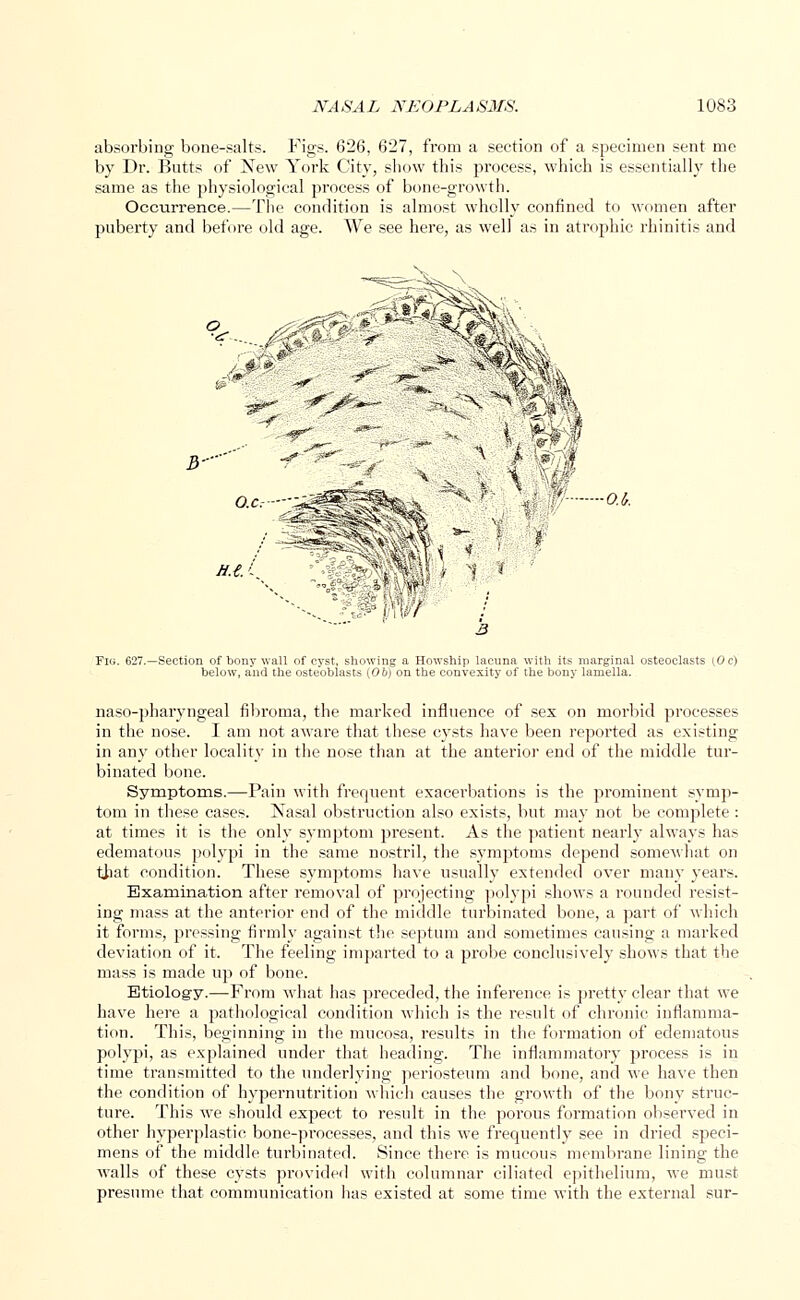 absorbing bone-salts. Figs. 626, 627, from a section of a specimen sent me by Dr. Butts of New York City, show this process, which is essentially the same as the physiological process of bone-growth. Occurrence.—The condition is almost wholly confined to women after puberty and before old age. We see here, as well as in atrophic rhinitis and -O.i. w$w Fig. 627.—Section of bony wall of cyst, showing a Howship lacuna with its marginal osteoclasts [Oc) below, a'nd the osteoblasts {Ob) on the convexity of the bony lamella. naso-pharyngeal fibroma, the marked influence of sex on morbid processes in the nose. I am not aware that these cysts have been reported as existing in any other locality in the nose than at the anterior end of the middle tur- binated bone. Symptoms.—Pain with frequent exacerbations is the prominent symp- tom in these cases. Xasal obstruction also exists, but may not be complete : at times it is the only symptom present. As the patient nearly always has edematous polypi in the same nostril, the symptoms depend somewhat on that condition. These symptoms have usually extended over many years. Examination after removal of projecting polypi shows a rounded resist- ing mass at the anterior end of the middle turbinated bone, a part of which it forms, pressing firmly against the septum and sometimes causing a marked deviation of it. The feeling imparted to a probe conclusively shows that the mass is made up of bone. Etiology.—From what has preceded, the inference is pretty clear that we have here a pathological condition which is the result of chronic inflamma- tion. This, beginning in the mucosa, results in the formation of edematous polypi, as explained under that heading. The inflammatory process is in time transmitted to the underlying periosteum and bone, and we have then the condition of hypernutrition which causes the growth of the bony struc- ture. This we should expect to result in the porous formation observed in other hyperplastic bone-processes, and this we frequently see in dried speci- mens of the middle turbinated. Since there is mucous membrane lining the walls of these cysts provided with columnar ciliated epithelium, we must presume that communication has existed at some time with the external sur-