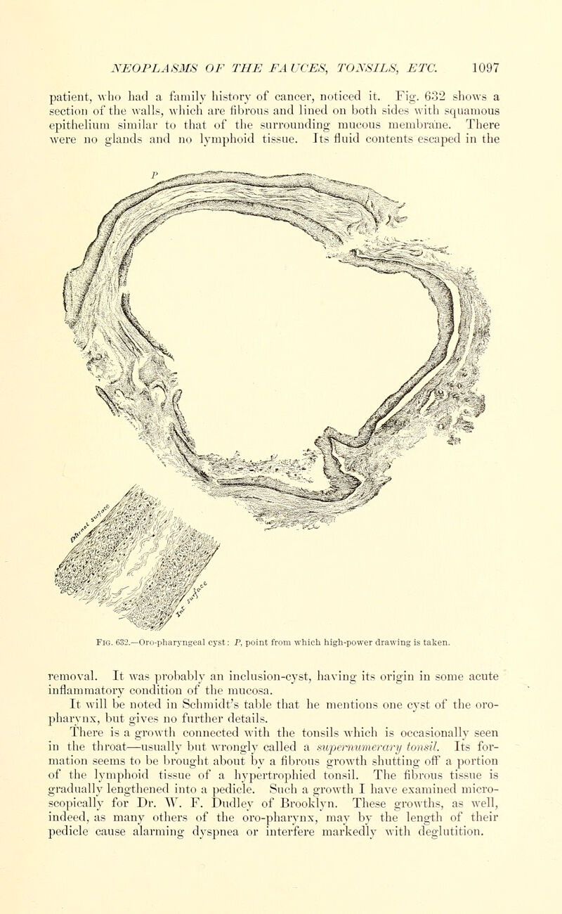 patient, who had a family history of cancer, noticed it. Fig. 632 shows a section of the walls, which are fibrous and lined on both sides with squamous epithelium similar to that of the surrounding mucous membrane. There were no glands and no lymphoid tissue. Its fluid contents escaped in the m _.---'. U':9 Fig. 632.—Oropharyngeal cyst: P, point from which high-power drawing is taken. removal. It was probably an inclusion-cyst, having its origin in some acute inflammatory condition of the mucosa. It will be noted in Schmidt's table that he mentions one cyst of the oro- pharynx, but gives no further details. There is a growth connected with the tonsils which is occasionally seen in the throat—usually but wrongly called a supernumerary tonsil. Its for- mation seems to be brought about by a fibrous growth shutting off a portion of the lymphoid tissue of a hypertrophied tonsil. The fibrous tissue is gradually lengthened into a pedicle. Such a growth I have examined micro- scopically for Dr. W. F. Dudley of Brooklyn. These growths, as well, indeed, as many others of the oro-pharynx, may by the length of their pedicle cause alarming dyspnea or interfere markedly with deglutition.