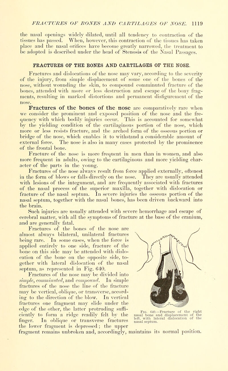 the nasal openings widely dilated, until all tendency to contraction of the tissues has passed. When, however, this contraction of the tissues has taken place and the nasal orifices have become greatly narrowed, the treatment to be adopted is described under the head of Stenosis of the Nasal Passages. FRACTURES OF THE BONES AND CARTILAGES OF THE NOSE. Fractures and dislocations of the nose may vary, according to the severity of the injury, from simple displacement of some one of the bones of the nose, without wounding the skin, to compound comminuted fracture of the bones, attended with more or less destruction and escape of the bony frag- ments, resulting in marked distortions and permanent disfigurement of the nose. Fractures of the bones of the nose are comparatively rare when we consider the prominent and exposed position of the nose and the fre- quency with which bodily injuries occur. This is accounted for somewhat by the yielding condition of the cartilaginous portion of the nose, which more or less resists fracture, and the arched form of the osseous portion or bridge of the nose, which enables it to withstand a considerable amount of external force. The nose is also in many cases protected by the prominence of the frontal bone. Fracture of the nose is more frequent in men than in women, and also more frequent in adults, owing to the cartilaginous and more yielding char- acter of the parts in the young. Fractures of the nose always result from force applied externally, oftenest in the form of blows or falls directly on the nose. They are usually attended with lesions of the integument, and are frequently associated with fractures of the nasal process of the superior maxilla, together with dislocation or fracture of the nasal septum. In severe injuries the osseous portion of the nasal septum, together with the nasal bones, has been driven backward into the brain. Such injuries are usually attended with severe hemorrhage and escape of cerebral matter, with all the symptoms of fracture at the base of the cranium, and are generally fatal. Fractures of the bones of the nose are almost always bilateral, unilateral fractures being rare. In some cases, when the force is applied entirely to one side, fracture of the bone on this side may be attended with dislo- cation of the bone on the opposite side, to- gether with lateral dislocation of the nasal septum, as represented in Fig. 640. Fractures of the nose may be divided into simple, comminuted, and compound. In simple fractures of the nose the line of the fracture may be vertical, oblique, or transverse, accord- ing to the direction of the blow. In vertical fractures one fragment may slide under the edge of the other, the latter protruding suffi- ciently to form a ridge readily felt by the finger. In oblique or transverse fractures the lower fragment is depressed; the upper fragment remains unbroken and, accordingly, maintains its normal position. Fig. 640.—Fracture of the right nasal bone and displacement of the left, with lateral dislocation of the nasal septum.