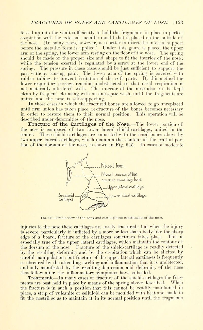 forced up into the vault sufficiently to hold the fragments in place in perfect coaptation with the external metallic mould that is placed on the outside of the nose. (In many cases, however, it is better to insert the internal support before the metallic form is applied.) Under this gauze is placed the upper arm of the spring, the lower arm resting on the floor of the nose. The spring should be made of the proper size and shape to fit the interior of the nose ; while the tension exerted is regulated by a screw at the lower end of the spring. The pressure in these cases should be just sufficient to support the part without causing pain. The lower arm of the spring is covered with rubber tubing, to prevent irritation of the soft parts. By this method the lower respiratory passage remains unobstructed, so that nasal respiration is not materially interfered with. The interior of the nose also can be kept clean by frequent cleansing with an antiseptic wash, until the fragments are united and the nose is self-supporting. In those cases in which the fractured bones are allowed to go un replaced until firm union has taken place, re-fracture of the bones becomes necessary in order to restore them to their normal position. This operation will be described under deformities of the nose. Fracture of the Cartilages of the Nose.—The lower portion of the nose is composed of two lower lateral shield-cartilages, united in the center. These shield-cartilages are connected with the nasal bones above by two upper lateral cartilages, which maintain the contour of the central por- tion of the dorsum of the nose, as shown in Fig. 645. In cases of moderate jl) 1__\ __Na.5Skl process of the JjJ >r\ superior maxillary bone. Jl _\ Upper lateral cartilage. Sesamoid //4X. ___\ .Lower lateral eartilag< cartilages (/K^S-^ \ Fig. 645.—Profile view of the bony and cartilaginous constituents of the nose. injuries to the nose these cartilages are rarely fractured; but when the injury is severe, particularly if inflicted by a more or less sharp body like the sharp edge of a board, fracture of the cartilages sometimes takes place. This is especially true of the upper lateral cartilages, which maintain the contour of the dorsum of the nose. Fracture of the shield-cartilage is readily detected by the resulting deformity and by the crepitation which can be elicited by careful manipulation ; but fracture of the upper lateral cartilages is frequently so obscured by the attending swelling and inflammation that it is undetected, and only manifested by the resulting depression and deformity of the nose that follow after the inflammatory symptoms have subsided. Treatment.—In many cases of fracture of the shield-cartilages the frag- ments are best held in place by means of the spring above described. \A hen the fracture is in such a position that this cannot be readily maintained in place, a strip of vulcanite or celluloid can be moulded with heat and made to fit the nostril so as to maintain it in its normal position until the fragments
