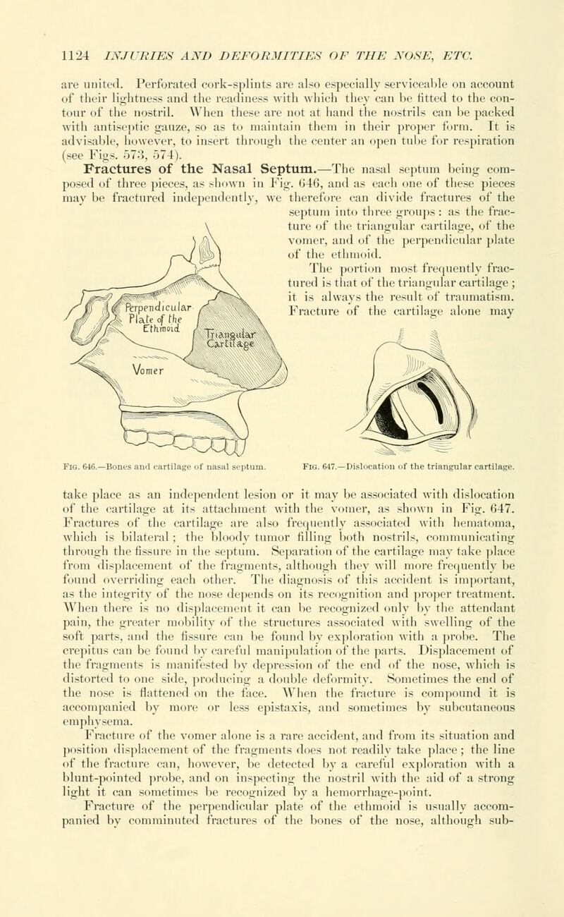 are united. Perforated cork-splints are also especially serviceable on account of their lightness and the readiness with which they can be fitted to the con- tour of the nostril. When these are not at hand the nostrils can l>e packed with antiseptic gauze, so as to maintain them in their proper form. It is advisable, however, to insert through the center an open tube for respiration (see Figs. 57.3, 574). Fractures of the Nasal Septum.—The nasal septum being com- posed of three pieces, as shown in Fig. 046, and as each one of these pieces may be fractured independently, we therefore can divide fractures of the septum into three groups : as the frac- ture of the triangular cartilage, of the vomer, and of the perpendicular plate of the ethmoid. The portion most frequently frac- tured is that of the triangular cartilage ; it is always the result of traumatism. Fracture of the cartilage alone may Fig. 646.—Bones anrl cartilage of nasal septum. Fig. 647.—Dislocation of the triangular cartilage. take place as an independent lesion or it may be associated with dislocation of the cartilage at its attachment with the vomer, as shown in Fig. 647. Fractures of the cartilage are also frequently associated with hematoma, which is bilateral ; the bloody tumor tilling both nostrils, communicating through the fissure in the septum. Separation of the cartilage may take place from displacement of the fragments, although they will more frequently be found overriding each other. The diagnosis of this accident is important, as the integrity of the nose depends on its recognition and proper treatment. When there is no displacement it can be recognized only by the attendant pain, the greater mobility of the structures associated with swelling of the soft parts, and the fissure can be found by exploration with a probe. The crepitus can be found by careful manipulation of the parts. Displacement of the fragments is manifested by depression of the end of the nose, which is distorted to one side, producing a double deformity. Sometimes the end of the nose is flattened on the face. When the fracture is compound it is accompanied by more or less epistaxis, and sometimes by subcutaneous emphysema. Fracture of the vomer alone is a rare accident, and from its situation and position displacement of the fragments docs not readily take place; the line of the fracture can, however, be detected by a careful exploration with a blunt-pointed probe, and on inspecting the nostril with the aid of a strong light it can sometimes be recognized by a hemorrhage-point. Fracture of the perpendicular plate of the ethmoid is usually accom- panied by comminuted fractures of the bones of the nose, although sub-