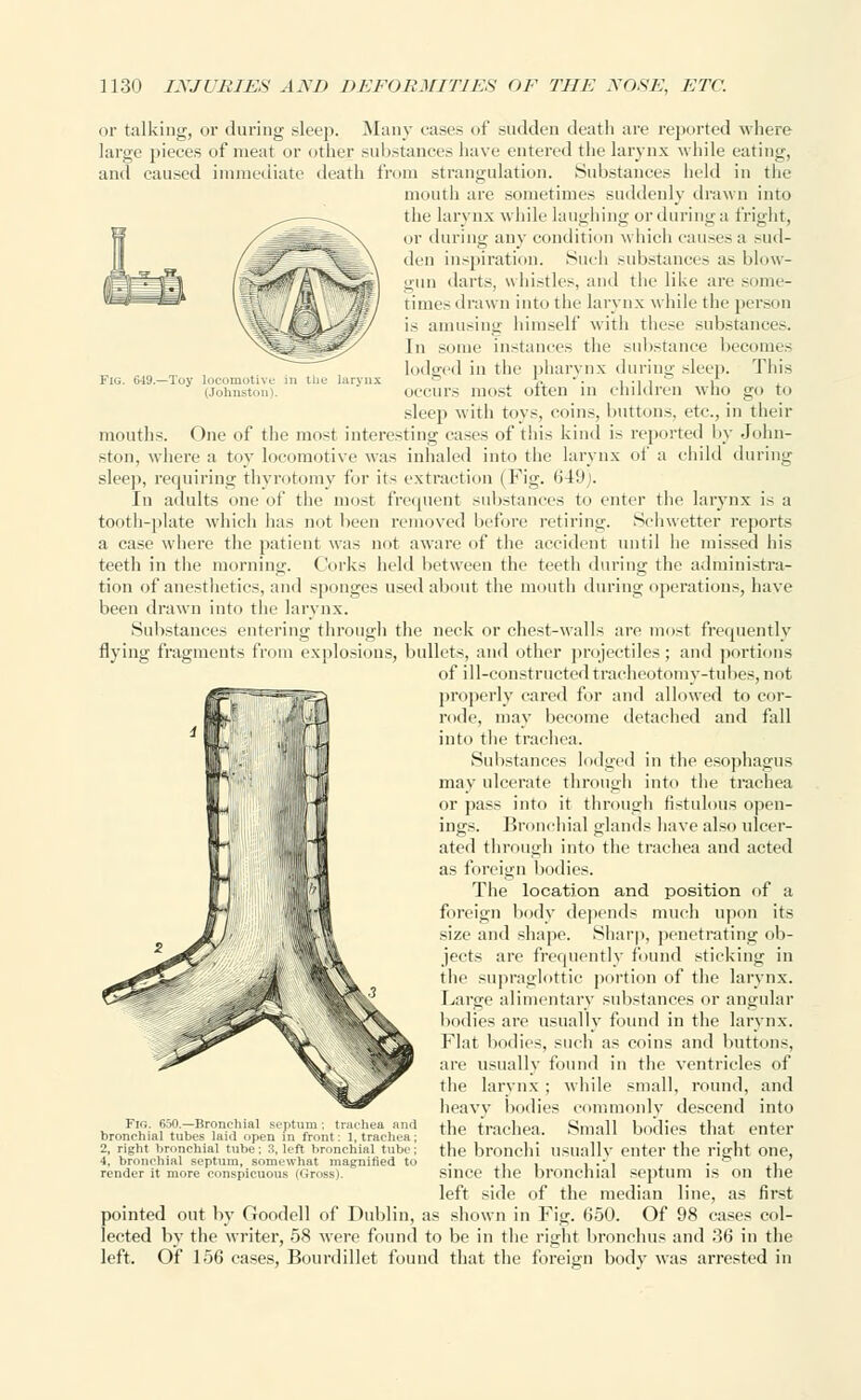 or talking, or during sleep. Many eases of sudden death are reported where large pieces of meat or other substances have entered the larynx while eating, and caused immediate death from strangulation. Substances held in the mouth are sometimes suddenly drawn into the larynx while laughing or during a fright, or during any condition which causes a Mid- den inspiration. Such substances as blow- gun darts, whistles, and the like are some- times drawn into the larynx while the person is amusing himself with these substances. In some instances the substance becomes lodged in the pharynx during sleep. This occurs most often in children who go to sleep with toys, coins, buttons, etc., in their mouths. One of the most interesting cases of this kind is reported by John- ston, where a toy locomotive was inhaled into the larynx of a child during sleep, requiring thyrotomy for its extraction (Fig. 649). In adults one of the most frequent substances to enter the larynx is a tooth-plate which has not been removed before retiring. Schwetter reports a case where the patient was not aware of the accident until he missed his teeth in the morning. Corks held between the teeth during the administra- tion of anesthetics, and sponges used about the mouth during operations, have been drawn into the larynx. Substances entering through the neck or chest-walls are most frequently flying fragments from explosions, bullets, and other projectiles ; and portions of ill-constructed tracheotomy-tubes, not properly eared for and allowed to cor- rode, may become detached and fall into the trachea. Substances lodged in the esophagus may ulcerate through into the trachea or pass into it through fistulous open- ings. Bronchial glands have also ulcer- ated through into the trachea and acted as foreign bodies. The location and position of a foreign body depends much upon its size and shape. Sharp, penetrating ob- jects are frequently found sticking in the supraglottic portion of the larynx. Large alimentary substances or angular bodies are usually found in the larynx. Flat bodies, such as coins and buttons, are usually found in the ventricles of the larynx ; while small, round, and heavy bodies commonly descend into the trachea. Small bodies that enter the bronchi usually enter the right one, since the bronchial septum is on the left side of the median line, as first pointed out by Goodell of Dublin, as shown in Fig. 650. Of 98 cases col- lected by the writer, 58 Avere found to be in the right bronchus and 36 in the left. Of 156 cases, Bourdillet found that the foreign body was arrested in Fig. 650.—Bronchial septum; trachea and bronchial tubes laid open in front: 1, trachea; 2, right bronchial tube ; 3, left bronchial tube ; 4, bronchial septum, somewhat magnified to render it more conspicuous (Gross).