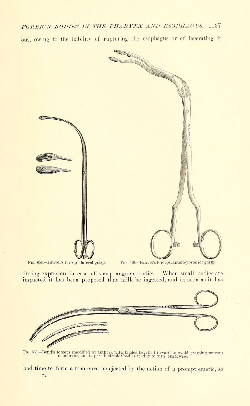 ous, owing to the liability of rupturing the esophagus or of lacerating it Fig. 658.—Fauvel's forceps, lateral grasp. Fig. 659.—Fauvel's forceps, antero-posterior grasp. during expulsion in case of sharp angular bodies. When small bodies are impacted it has been proposed that milk be ingested, and as soon as it has Fig. 660.—Bond's forceps (modified by author), with blades bevelled inward to avoid grasping mucous membrane, and to permit slender bodies readily to turn lengthwise. had time to form a firm curd be ejected by the action of a prompt emetic, so