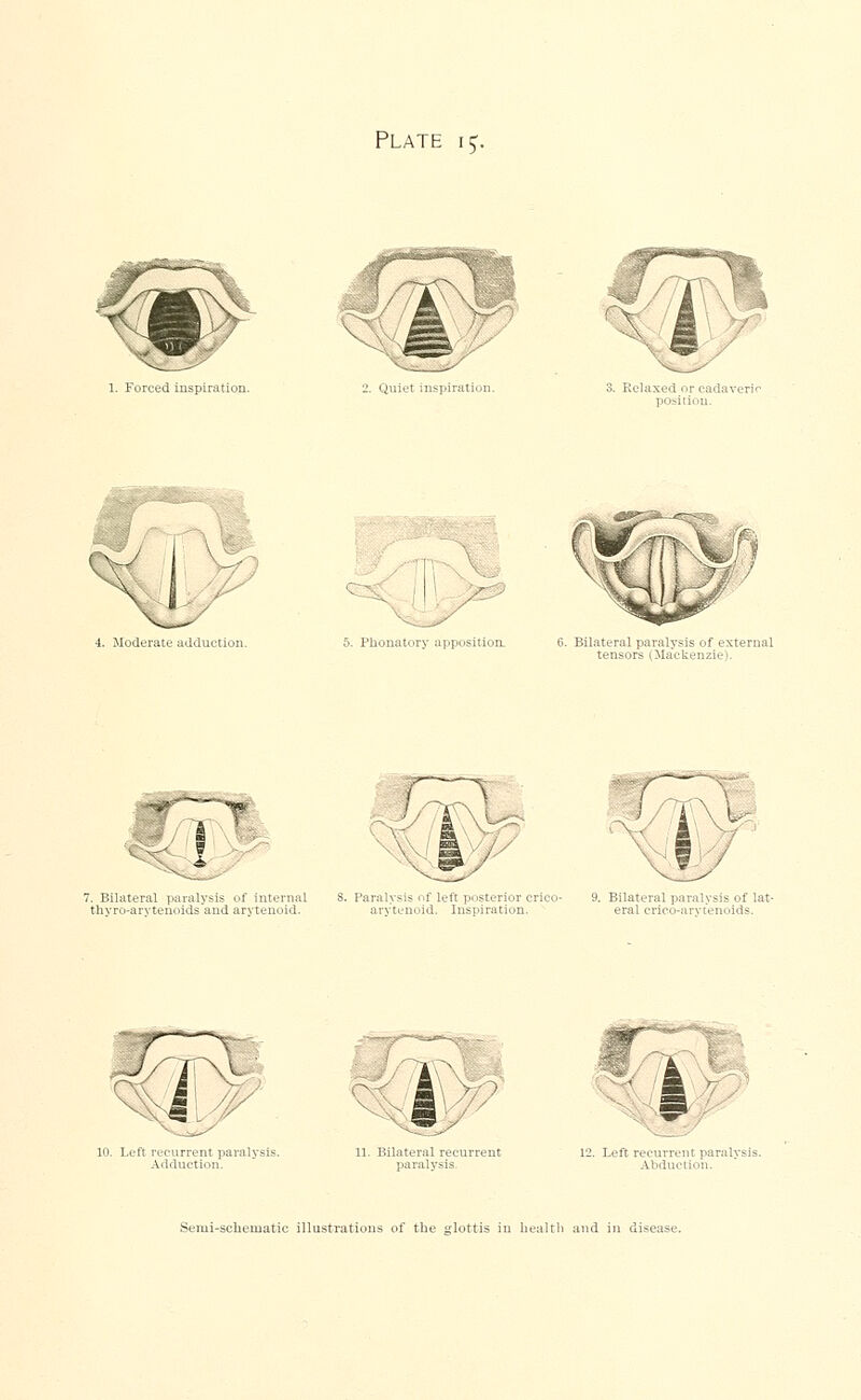 Plate 15. 1. Forced inspiration. '2. Quiet inspiration. Relaxed or cadaveric position. ■i. Moderate adduction. 5. Phonatory apposition. 7. Bilateral paralysis of internal thyro-arytenoids and arytenoid. 11. Bilateral recurrent paralysis Semi-schematic illustrations of the glottis in health and in disease.