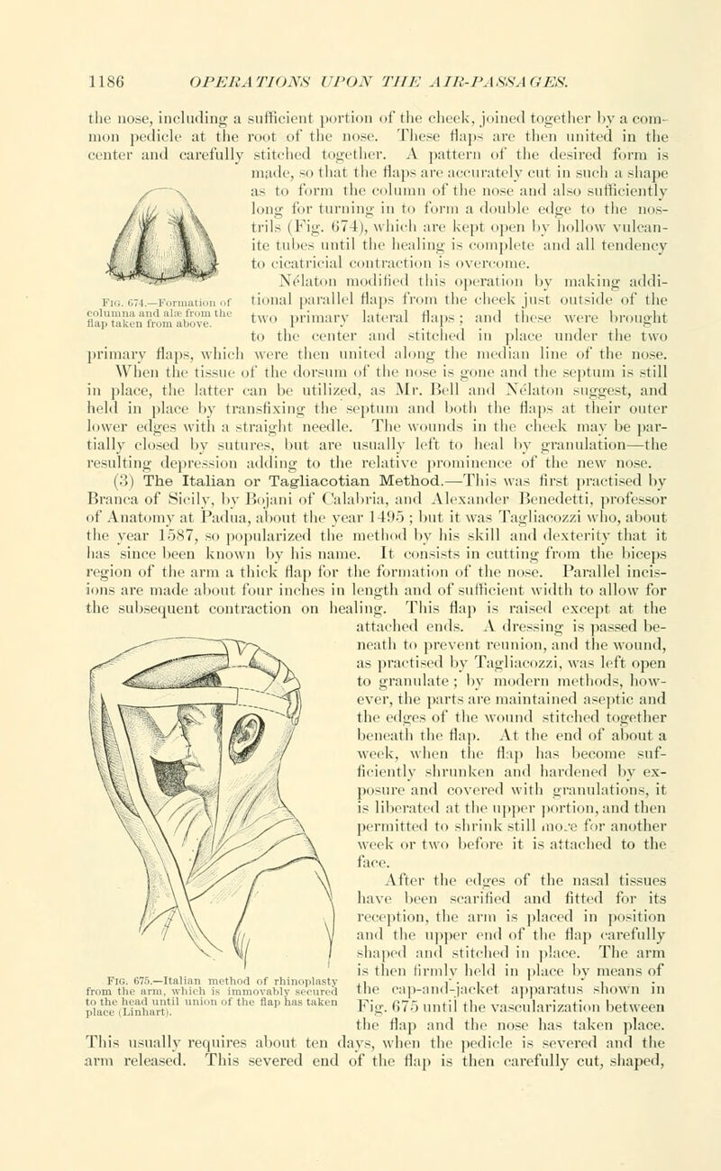 Fig. 674.—Formation o columna and alse Prom tli nap taken from above. the nose, including a sufficient portion of the cheek, joined together by a com- mon pedicle at the root of the nose. These flaps are then united in the center and carefully stitched together. A pattern of the desired form is made, so that the flaps are accurately cut in such a shape as to form the column of the nose and also sufficiently long for turning in to form a double edge to the nos- trils (Fig. 674), which arc kept open by hollow vulcan- ite tubes until the healing is complete and all tendency to cicatricial contraction is overcome. Nedaton modified this operation by making addi- tional parallel flaps from the cheek just outside of the two primary lateral flaps ; and these were brought to the center ami stitched in place under the two primary flaps, which were then united along the median line of the nose. When the tissue of the dorsum of the nose is gone and the septum is still in place, the latter can be utilized, as Mr. Bell and Nelaton suggest, and held in place by transfixing the septum and both the Haps at their outer lower edges with a straight needle. The wounds in the cheek may he par- tially closed by sutures, but are usually left to heal by granulation—the resulting depression adding to the relative prominence of the new nose. (3) The Italian or Tag-liacotian Method.—This was first practised by Branca of Sicily, by Bojani of Calabria, and Alexander Benedetti, professor of Anatomy at Padua, about the year 1495 ; but it was Tagliaoozzi who, about the year 1587, so popularized the method by his skill and dexterity that it has since been known by his name. It consists in cutting from the biceps region of the arm a thick flap for the formation of the nose. Parallel incis- ions are made about four inches in length and of sufficient width to allow for the subsequent contraction on healing. This flap is raised except at the attached ends. A dressing is passed be- neath to prevent reunion, and the wound, as practised by Tagliacozzi, was left open to granulate: by modern methods, how- ever, the parts are maintained aseptic and the edges of the wound stitched together beneath the flap. At the end of about a week, when the flap has become suf- ficiently shrunken and hardened by ex- posure and covered with granulations, it is liberated at the upper portion, and then permitted to shrink still mo.v for another week or two before it is attached to the face. After the edu'es of the nasal tissues have been scarified and fitted for its reception, the arm is placed in position and the upper end of the flap carefully shaped and stitched in place. The arm is then firmly held in place by means of the cap-and-jacket apparatus shown in Fig. 675 until the vascularization between the flap and the nose lias taken place. This usually requires about ten days, when the pedicle is severed and the arm released. This severed end of the flap is then carefully cut, shaped, Fig. 675.—Italian method of rhinoplasty from the arm, which is immovably secured to the heart until union of the flap has taken place (Linhart).