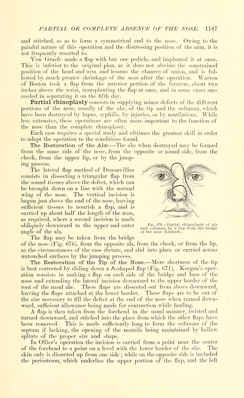 and stitched, so as to form a symmetrical end to the nose. Owing to the painful nature of this operation and the distressing position of the arm, it is not frequently resorted to. Von Graefe made a flap with but one pedicle, and implanted it at once. This is inferior to the original plan, as it does not obviate the constrained position of the head and arm and lessens the chances of union, and is fol- lowed by much greater shrinkage of the nose after the operation. Warren of Boston took a flap from the anterior portion of the forearm, about two inches above the wrist, transplanting the flap at once, and in some cases suc- ceeded in separating it on the fifth day. Partial rhinoplasty consists in supplying minor defects of the different portions of the nose, usually of the aire, of the tip and the columna, which have been destroyed by lupus, syphilis, by injuries, or by mutilations. While less extensive, these operations are often more important to the function of the nose than the complete rhinoplasty. Each case requires a special study and ofttimes the greatest skill in order to adapt the operation to the conditions found. The Restoration of the Alee.—The aire when destroyed may be formed from the same side of the nose, from the opposite or sound side, from the cheek, from the upper lip, or by the jump- ing process. The lateral flap method of Denonvillier sJ? consists in dissecting a triangular flap from the sound tissues above the defect, which can be brought down on a line with the normal wing of the nose. The vertical incision is begun just above the end of the nose, leaving sufficient tissues to nourish a flap, and is carried up about half the length of the nose, as required, where a second incision is made obliquely downward to the upper and outer /IG; 676.-Partiai rhinoplasty of aia Jl • L * and columna by a nap from the bridge allele 01 the ala. of the nose (Lirihart). The flap may be taken from the bridge of the nose (Fig. 676), from the opposite ala, from the cheek, or from the lip, as the circumstances of the case dictate, and slid into place or carried across untouched surfaces by the jumping process. The Restoration of the Tip of the Nose.—Mere shortness of the tip is best corrected by sliding down a A-shaped flap (Fig. 671). Keegan's oper- ation consists in making a flap on each side of the bridge and base of the nose and extending the lateral incision downward to the upper border of the root of the nasal aire. These flaps are dissected out from above downward, leaving the flaps attached at the lower border. These flaps are to be cut of the size necessary to fill the defect at the end of the nose when turned down- ward, sufficient allowance being made for contraction while healing. A flap is then taken from the forehead in the usual manner, twisted and turned downward, and stitched into the place from which the other flaps have been removed. This is made sufficiently long to form the columna of the septum if lacking, the opening of the nostrils being maintained by hollow splints of the proper size and shape. In Ollier's operation the incision is carried from a point near the center of the forehead to a point on a level with the lower border of the aire. The skin only is dissected up from one side ; while on the opposite side is included the periosteum, which underlies the upper portion of the flap, and the left