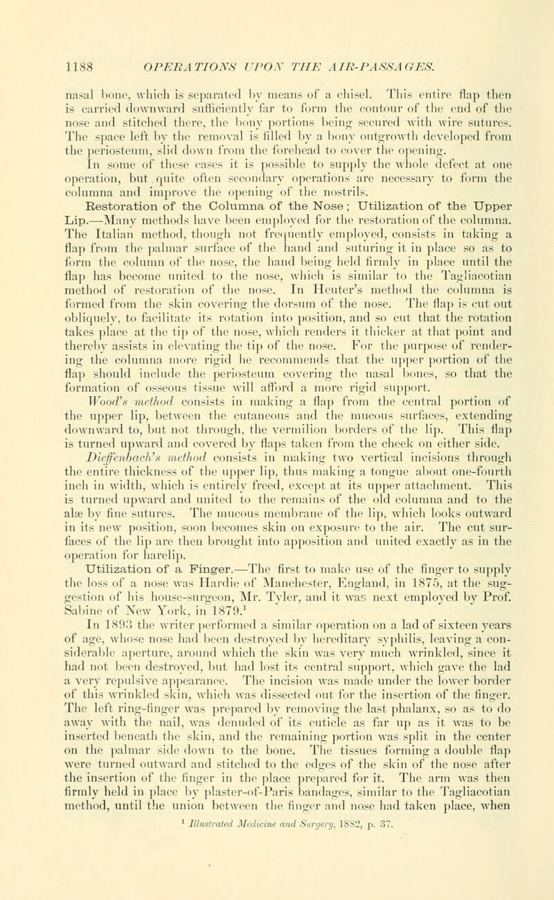 nasal bone, which is separated by means of a chisel. This entire flap then is carried downward sufficiently far to form the contour of the end of the nose and stitched there, the bony portions being secured with wire sutures. The spaee left by the removal is tilled by a bony outgrowth developed from the periosteum, slid down from the forehead to cover the opening. In some of these cases it is possible to supply the whole defect at one operation, but quite often secondary operations are necessary to form the columna and improve the opening of the nostrils. Restoration of the Columna of the Nose; Utilization of the Upper Lip.—Many methods have been employed for the restoration of the columna. The Italian method, though not frequently employed, consists in taking a flap from the palmar surface of the hand and suturing it in place so as to form the column of the nose, the hand being held firmly in place until the flap has become united to the nose, which is similar to the Tagliacotian method of restoration of the nose. In Heuter's method the columna is formed from the skin covering the dorsum of the nose. The flap is cut out obliquely, to facilitate its rotation into position, and so cut that the rotation takes place at the tip of the nose, which renders it thicker at that point and thereby assists in elevating the tip of the nose. For the purpose of render- ing the columna more rigid he recommends that the upper portion of the flap should include the periosteum covering the nasal bones, so that the formation of osseous tissue will afford a more rigid support. Wood's method consists in making a flap from the central portion of the upper lip, between the cutaneous and the mucous surfaces, extending downward to, but not through, the vermilion borders of the lip. This flap is turned upward and covered by flaps taken from the cheek on either side. Dieffenbach's method consists in making two vertical incisions through the entire thickness of the upper lip, thus making a tongue about one-fourth inch in width, which is entirely freed, except at its upper attachment. This is turned upward and united to the remains of the old columna and to the ahe by fine sutures. The mucous membrane of the lip, which looks outward in its new position, soon becomes skin on exposure to the air. The cut sur- faces of the lip are then brought into apposition and united exactly as in the operation for harelip. Utilization of a Finger.—The first to make use of the finger to supply the loss of a nose was Ilardie of Manchester, England, in 1875, at the sug- gestion of his house-surgeon, Mr. Tyler, and it was next employed by Prof. Sabine of New York, in 1879.1 In 1893 the writer performed a similar operation on a lad of sixteen years of age, whose nose had been destroyed by hereditary syphilis, leaving a con- siderable aperture, around which the skin was very much wrinkled, since it had not been destroyed, but had lost its central support, which gave the lad a very repulsive appearance. The incision was made under the lower border of this wrinkled skin, which was dissected out for the insertion of the finger. The left ring-finger was prepared by removing the last phalanx, so as to do away with the nail, was denuded of its cuticle as far up as it was to be inserted beneath the skin, and the remaining portion was split in the center on the palmar side down to the bone. The tissues forming a double flap were turned outward and stitched to the edges of the skin of the nose after the insertion of the finger in the place prepared for it. The arm was then firmly held in place by plaster-of-Paris bandages, similar to the Tagliacotian method, until the union between the finger and nose had taken place, when 1 Illustrated Malicine awl Suri/cnj, 1SX2, ]>. oT.