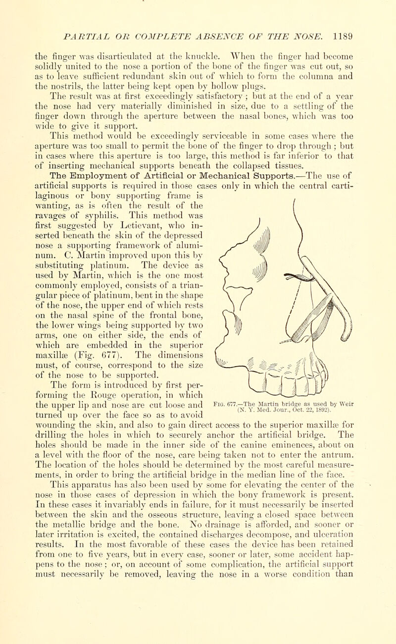 the finger was disarticulated at the knuckle. When the finger had become solidly united to the nose a portion of the bone of the finger was cut out, so as to leave sufficient redundant skin out of which to form the columna and the nostrils, the latter being kept open by hollow plugs. The result was at first exceedingly satisfactory ; but at the end of a year the nose had very materially diminished in size, due to a settling of the finger down through the aperture between the nasal bones, which was too wide to give it support. This method would be exceedingly serviceable in some cases where the aperture was too small to permit the bone of the finger to drop through ; but in cases where this aperture is too large, this method is far inferior to that of inserting mechanical supports beneath the collapised tissues. The Employment of Artificial or Mechanical Supports.—The use of artificial supports is required in those cases only in which the central carti- laginous or bony supporting frame is wanting, as is often the result of the ravages of syphilis. This method was first suggested by Letievant, who in- serted beneath the skin of the depressed nose a supporting framework of alumi- num. C. Martin improved upon this by substituting platinum. The device as used by Martin, which is the one most commonly employed, consists of a trian- gular piece of platinum, bent in the shape of the nose, the upper end of which rests on the nasal spine of the frontal bone, the lower wings being supported by two arms, one on either side, the ends of which are embedded in the superior maxilla? (Fig. 677). The dimensions must, of course, correspond to the size of the nose to be supported. The form is introduced by first per- forming the Rouge operation, in which the upper lip and nose are cut loose and turned up over the face so as to avoid wounding the skin, and also to gain direct access to the superior maxilla? for drilling the holes in which to securely anchor the artificial bridge. The holes should be made in the inner side of the canine eminences, about on a level with the floor of the nose, care being taken not to enter the antrum. The location of the holes should be determined by the most careful measure- ments, in order to bring the artificial bridge in the median line of the face. This apparatus has also been used by some for elevating the center of the nose in those cases of depression in which the bony framework is present. In these cases it invariably ends in failure, for it must necessarily be inserted between the skin and the osseous structure, leaving a closed space between the metallic bridge and the bone. No drainage is afforded, and sooner or later irritation is excited, the contained discharges decompose, and ulceration results. In the most favorable of these cases the device has been retained from one to five years, but in every case, sooner or later, some accident hap- pens to the nose; or, on account of some complication, the artificial support must necessarily be removed, leaving: the nose in a worse condition than