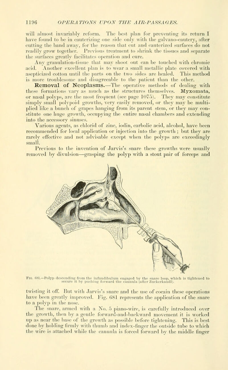 will almost invariably reform. The best plan for preventing its return I have found to be in cauterizing one side only with the galvano-cautery, after cutting the band away, for the reason that cut and cauterized surfaces do not readily grow together. Previous treatment to shrink the tissues and separate the surfaces greatly facilitates operation and cure. Any granulation-tissue that may shoot out can be touched with chromic acid. Another excellent plan is to wear a small metallic plate covered with asepticized cotton until the parts on the two sides are healed. This method is more troublesome and disagreeable to the patient than the other. Removal of Neoplasms.—The operative methods of dealing with these formations vary as much as the structures themselves. Myxomata, or nasal polyps, are the most frequent (see page 1075). They may constitute simply small polypoid growths, very easily removed, or they may be multi- plied like a bunch of grapes hanging from its parent stem, or they may con- stitute one huge growth, occupying the entire nasal chambers and extending into the accessory sinuses. Various agents, as chlorid of zinc, iodin, carbolic acid, alcohol, have been recommended for local application or injection into the growth; but they are rarely effective and not advisable except when the polyps are exceedingly small. Previous to the invention of Jarvis's snare these growths were usually removed by divulsion—grasping the polyp with a stout pair of forceps and Fig. 681.—Polyp descending from the infundibulum engaged by the snare loop, which is tightened to secure it by pushing forward the cannula (alter Zuckerkandl). twisting it off. But with Jarvis's snare and the use of cocain these operations have been greatly improved. Fig. 681 represents the application of the snare to a polyp in the nose. The snare, armed with a No. .r> piano-wire, is carefully introduced over the growth, then by a gentle forward-and-backward movement it is worked up as near the base of the growth as possible before tightening. This is best done by holding firmly with thumb and index-finger the outside tube to which the wire is attached while the cannula is forced forward by the middle finger