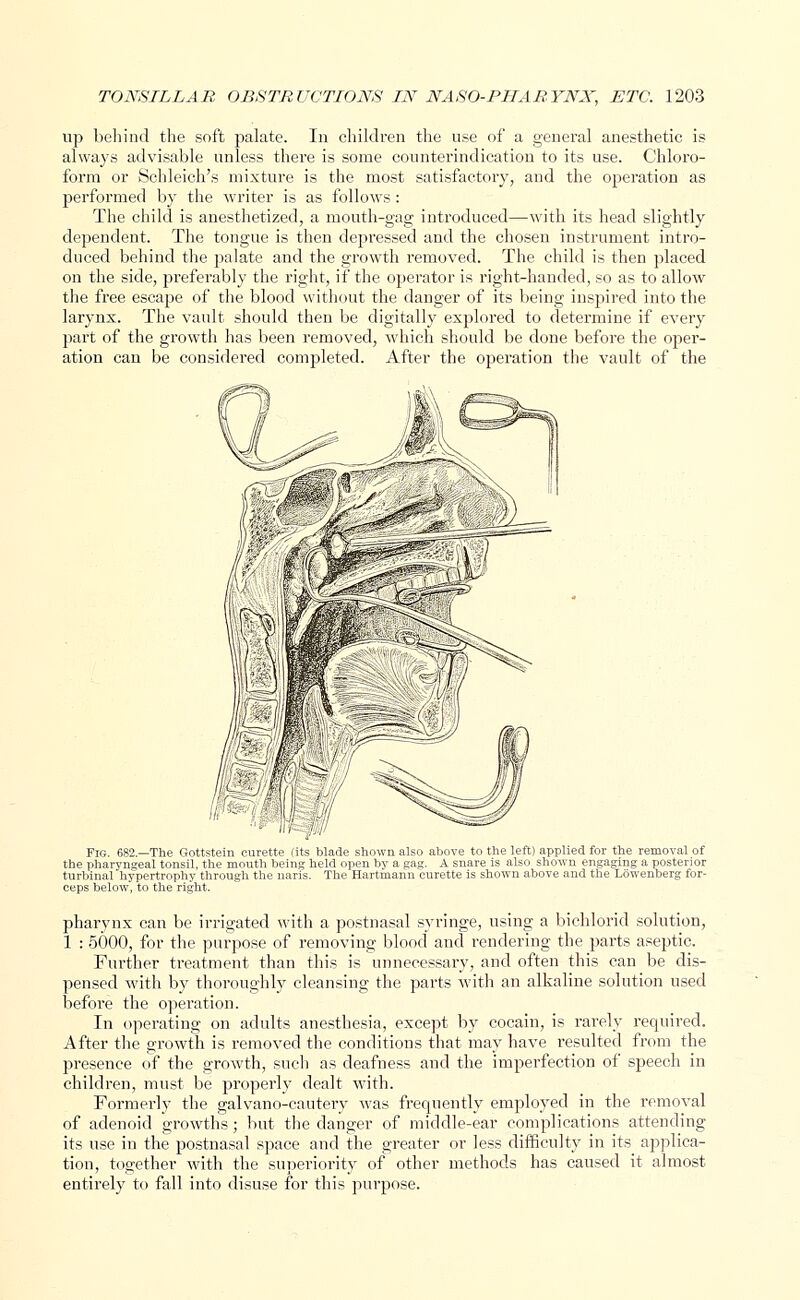 up behind the soft palate. In children the use of a general anesthetic is always advisable unless there is some counterindication to its use. Chloro- form or Schleich's mixture is the most satisfactory, and the operation as performed by the writer is as follows: The child is anesthetized, a mouth-gag introduced—with its head slightly dependent. The tongue is then depressed and the chosen instrument intro- duced behind the palate and the growth removed. The child is then placed on the side, preferably the right, if the operator is right-handed, so as to allow the free escape of the blood without the danger of its being inspired into the larynx. The vault should then be digitally explored to determine if every part of the growth has been removed, which should be done before the oper- ation can be considered completed. After the operation the vault of the Fig. 682.—The Gottstein curette (its blade shown also above to the left) applied lor the removal of the pharyngeal tonsil, the mouth hems; held open by a gag. A snare is also shown engaging a posterior turbinal hypertrophy through the nans. The Hartmann curette is shown above and the Lowenberg for- ceps below, to the right. pharynx can be irrigated with a postnasal syringe, using a bichlorid solution, 1 : 5000, for the purpose of removing blood and rendering the parts aseptic. Further treatment than this is unnecessary, and often this can be dis- pensed with by thoroughly cleansing the parts with an alkaline solution used before the operation. In operating on adults anesthesia, except by cocain, is rarely required. After the growth is removed the conditions that may have resulted from the presence of the growth, such as deafness and the imperfection of speech in children, must be properly dealt with. Formerly the galvano-cautery was frequently employed in the removal of adenoid growths; but the danger of middle-ear complications attending its use in the postnasal space and the greater or less difficulty in its applica- tion, together with the superiority of other methods has caused it almost entirely to fall into disuse for this purpose.