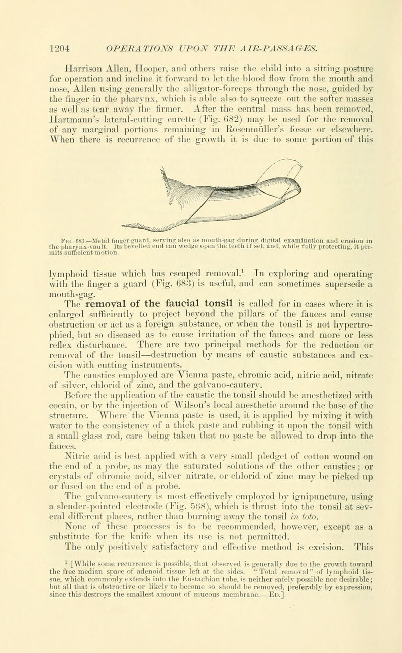 Harrison Allen, Hooper, and others raise the child into a sitting posture for operation and incline it forward to let the blood flow from the mouth and nose, Allen using generally the alligator-forceps through the nose, guided by the finger in the pharynx, which is able also to squeeze out the softer masses as well as tear away the firmer. After the central mass lias been removed, Hartmann's lateral-cutting curette (Fig. 682) may lie used for the removal of any marginal portions remaining in Rosen m.iiller's fosste or elsewhere. When there is recurrence of the growth it is due to some portion of this Fig. 683.—Metal finger-guard, serving also as mouth-gag during digital examination and erasion in the pharynx-vault. Its bevelled end can wedge open the teeth if set, and, while fully protecting, it per- mits sufficient motion. lymphoid tissue which lias escaped removal.1 In exploring and operating with the finger a guard (Fig. 683) is useful, and can sometimes supersede a mouth-gag. The removal of the faucial tonsil is called for in cases where it is enlarged sufficiently to project beyond the pillars of the fauces and cause obstruction or act as a foreign substance, or when the tonsil is not hypertro- phied, but so diseased as to cause irritation of the fancies and more or less reflex disturbance. There are two principal methods for the reduction or removal of the tonsil—destruction by means of caustic substances and ex- cision with cutting instruments. The caustics employed are Vienna paste, chromic acid, nitric acid, nitrate of silver, chlorid of zinc, and the galvano-cautery. Before the application of the caustic the tonsil should be anesthetized with cocain, or by the injection of Wilson's local anesthetic around the base of the structure. Where the Vienna paste is used, it is applied by mixing it with water to the consistency of a thick paste and rubbing it upon the tonsil with a small glass rod, care being taken that no paste be allowed to drop into the fauces. Nitric acid is best applied witli a very small pledget of cotton wound on the end of a probe, as may the saturated solutions of the other caustics ; or crystals of chromic acid, silver nitrate, or chlorid of zinc may be picked up or fused on the end of a probe. The galvano-cautery is most effectively employed bv ignipuncture, using a slender-pointed electrode (Fig. 568), which is thrust into the tonsil at sev- eral different places, rather than burning away the tonsil /'// toto. None of these processes is to be recommended, however, except as a substitute for the knife when its use is not permitted. The only positively satisfactory and effective method is excision. This 1 [While some recurrence is possible, that observed is generally due to the growth toward the free median spare of adenoid tissue left at the sides. Total removal of lymphoid tis- sue, which commonly extends into the Eustachian tube, is neither safely possible nor desirable; but all that is obstructive or likely to become so should be removed, preferably by expression, since this destroys the smallest amount of mucous membrane.—Ed.]