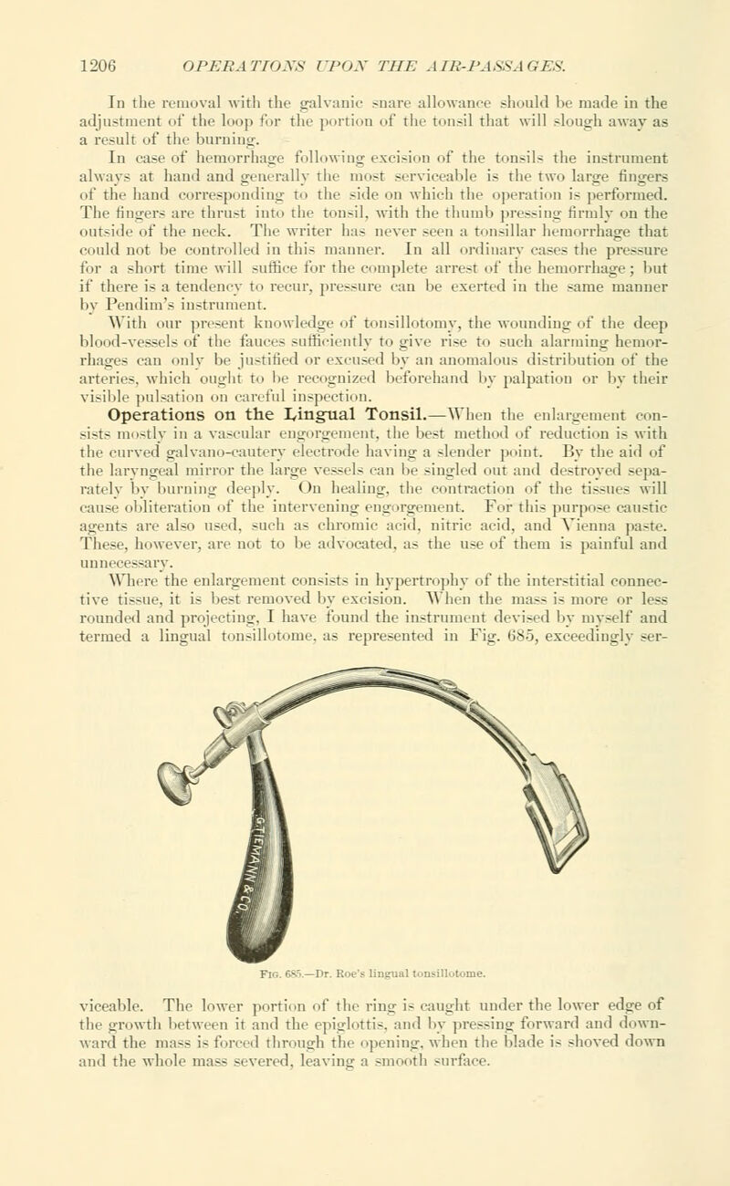 In the removal with the galvanic snare allowance should be made in the adjustment of the loop for the portion of the tonsil that will slough away as a result of the burning. In case of hemorrhage following excision of the tonsils the instrument always at hand and generally the most serviceable is the two large fingers of the hand corresponding to the side on which the operation is performed. The linger- are thrust into the tonsil, with the thumb pressing firmly on the outside of the neck. The writer has never seen a tonsillar hemorrhage that could not be controlled in this maimer. In all ordinary cases the pressure for a short time will suffice lor the complete arrest of the hemorrhage; but if there i- a tendency to recur, pressure can be exerted in the same manner by Pendim's instrument. With our present knowledge of tonsillotomy, the wounding of the deep blood-vessels of the fauces sufficiently to give rise to such alarming hemor- rhages can only be justified or excused by an anomalous distribution of the arteries, which ought to be recognized beforehand by palpation or by their visible pulsation on careful inspection. Operations on the lingual Tonsil.—When the enlargement con- sists mostly in a vascular engorgement, the best method of reduction is with the curved galvano-cautery electrode having a slender point. By the aid of the laryngeal mirror the large vessels can be singled out and destroyed sepa- rately by burning deeply. On healing, the contraction of the tissues will cause obliteration of the intervening engorgement. For this purpose caustic agents are also used, such as chromic acid, nitric acid, and Vienna paste. These, however, are not to be advocated, as the use of them is painful and unnecessary. Where the enlargement consists in hypertrophy of the interstitial connec- tive tissue, it is best removed by excision. When the mass is more or less rounded and projecting, I have found the instrument devised by myself and termed a lingual tonsillotome, as represented in Fig. 685, exceedingly ser- »ual tonsillotome. viceable. The lower portion of the ring i- caught under the lower edge of the growth between it and the epiglottis, and by pressing forward and down- ward the mass is forced through the opening, when the blade is shoved down and the whole mass severed, leaving a smooth surface.