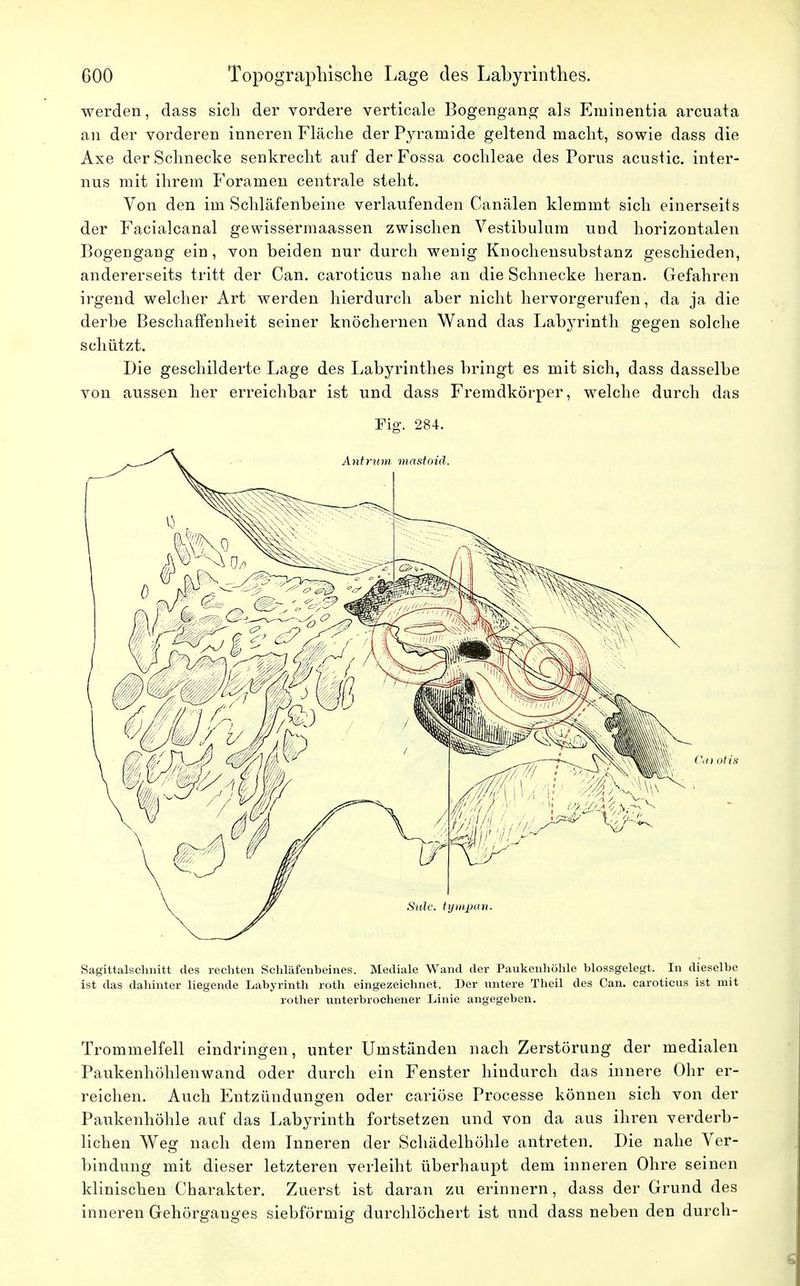 werden, dass sich der vordere verticale Bogengang als Eminentia arcuata an der vorderen inneren Fläche der Pyramide geltend macht, sowie dass die Axe der Schnecke senkrecht auf der Fossa Cochleae des Poms acustic. inter- nus mit ihrem Foramen centrale steht. Yon den im Schläfenbeine verlaufenden Canälen klemmt sich einerseits der Facialcanal gewissermaassen zwischen Vestibulum und horizontalen Bogengang ein, von beiden nur durch wenig Knochensubstanz geschieden, andererseits tritt der Can. caroticus nahe an die Schnecke heran. Gefahren irgend welcher Art werden hierdurch aber nicht hervorgerufen , da ja die derbe Beschaffenheit seiner knöchernen Wand das Labyrinth gegen solche schützt. Die geschilderte Lage des Labyrinthes bringt es mit sich, dass dasselbe von aussen her erreichbar ist und dass Fremdkörper, welche durch das Fig. 284. Sagittalschnitt des rechten Schläfenbeines. Mediale Wand der Paukenhöhle blossgelegt. In dieselbe ist das dahinter liegende Labyrinth roth eingezeichnet. Der untere Theil des Can. caroticus ist mit rother unterbrochener Linie angegeben. Trommelfell eindringen, unter Umständen nach Zerstörung der medialen Paukenhöhlenwand oder durch ein Fenster hindurch das innere Ohr er- reichen. Auch Entzündungen oder cariöse Processe können sich von der Paukenhöhle auf das Labyrinth fortsetzen und von da aus ihren verderb- lichen Weg nach dem Inneren der Schädelhöhle antreten. Die nahe Ver- bindung mit dieser letzteren verleiht überhaupt dem inneren Ohre seinen klinischen Charakter. Zuerst ist daran zu erinnern, dass der Grund des inneren Gehörgauges siebförmig durchlöchert ist und dass neben den durch-