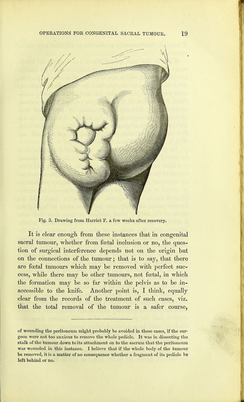 Fig. 3. Drawing from Harriet F. a few weeks after recovery. It is clear enough from these instances that in congenital sacral tumour, whether from foetal inclusion or no, the ques- tion of surgical interference depends not on the origin but on the connections of the tumour; that is to say, that there are foetal tumours which may be removed with perfect suc- cess, while there may be other tumours, not foetal, in which the formation may be so far within the pelvis as to be in- accessible to the knife. Another point is, I think, equally clear from the records of the treatment of such cases, viz. that the total removal of the tumour is a safer course, of wounding the peritoneum might probably be avoided in these cases, if the sur- geon were not too anxious to remove the whole pedicle. It was in dissecting the stalk of the tumour down to its attachment on to the sacrum that the peritoneum was wounded in this instance. I believe that if the whole body of the tumour be removed, it is a matter of no consequence whether a fragment of its pedicle be left behind or no.