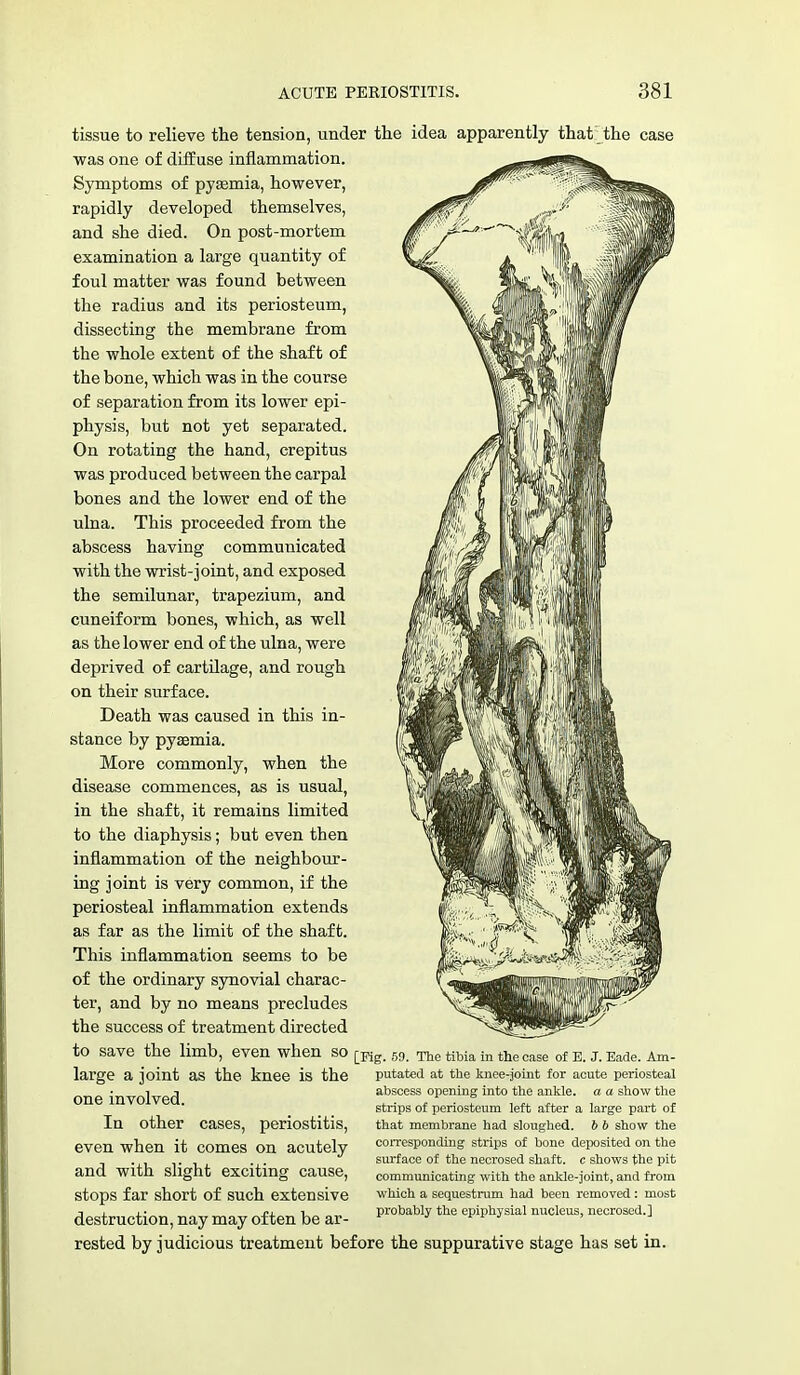 tissue to relieve the tension, under the idea apparently that the case was one of diffuse inflammation. Symptoms of pyaemia, however, rapidly developed themselves, and she died. On post-mortem examination a large quantity of foul matter was found between the radius and its periosteum, dissecting the membrane from the whole extent of the shaft of the bone, which was in the course of separation from its lower epi- physis, but not yet separated. On rotating the hand, crepitus was produced between the carpal bones and the lower end of the ulna. This proceeded from the abscess having communicated with the wrist-joint, and exposed the semilunar, trapezium, and cuneiform bones, which, as well as the lower end of the ulna, were deprived of cartilage, and rough on their surface. Death was caused in this in- stance by pyaemia. More commonly, when the disease commences, as is usual, in the shaft, it remains limited to the diaphysis; but even then inflammation of the neighbour- ing joint is very common, if the periosteal inflammation extends as far as the limit of the shaft. This inflammation seems to be of the ordinary synovial charac- ter, and by no means precludes the success of treatment directed to save the limb, even when SO [Kg. 59. The tibia in the case of E. J. Eade. Am- putated at the knee-joint for acute periosteal abscess opening into the ankle, a a show the strips of periosteum left after a large part of that membrane had sloughed, b b show the corresponding strips of bone deposited on the surface of the necrosed shaft, c shows the pit communicating with the ankle-joint, and from which a sequestrum had been removed: most probably the epiphysial nucleus, necrosed.] large a joint as the knee is the one involved. In other cases, periostitis, even when it comes on acutely and with slight exciting cause, stops far short of such extensive destruction, nay may often be ar- rested by judicious treatment before the suppurative stage has set in.