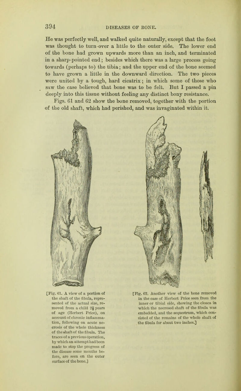 He was perfectly well, and walked quite naturally, except that the foot was thought to turn-over a little to the outer side. The lower end of the bone had grown upwards more than an inch, and terminated in a sharp-pointed end; besides which there was a large process going towards (perhaps to) the tibia; and the upper end of the bone seemed to have grown a little in the downward direction. The two pieces were united by a tough, hard cicatrix; in which some of those who saw the case believed that bone was to be felt. But I passed a pin deeply into this tissue without feeling any distinct bony resistance. Figs. 61 and 62 show the bone removed, together with the portion of the old shaft, which had perished, and was invaginated within it. [Fig. CI. A view of a portion of the shaft of the fibula, repre- sented of the actual size, re- moved from a child 2J years of age (Herbert Price), on account of chronic inflamma- tion, following on acute ne- crosis of the whole thickness of the shaft of the fibula. The traces of a previous operation, by which an attempt had been made to stop the progress of the disease some months be- fore, are seen on the outer surface of the bone.] M [Fig. G2. Another view of the bone removed in the case of Herbert Price seen from the inner or tibial side, showing the cloaca in which the necrosed shaft of the fibula was embedded, and the sequestrum, which con- sisted of the remains of the whole shaft of the fibula for about two inches.]