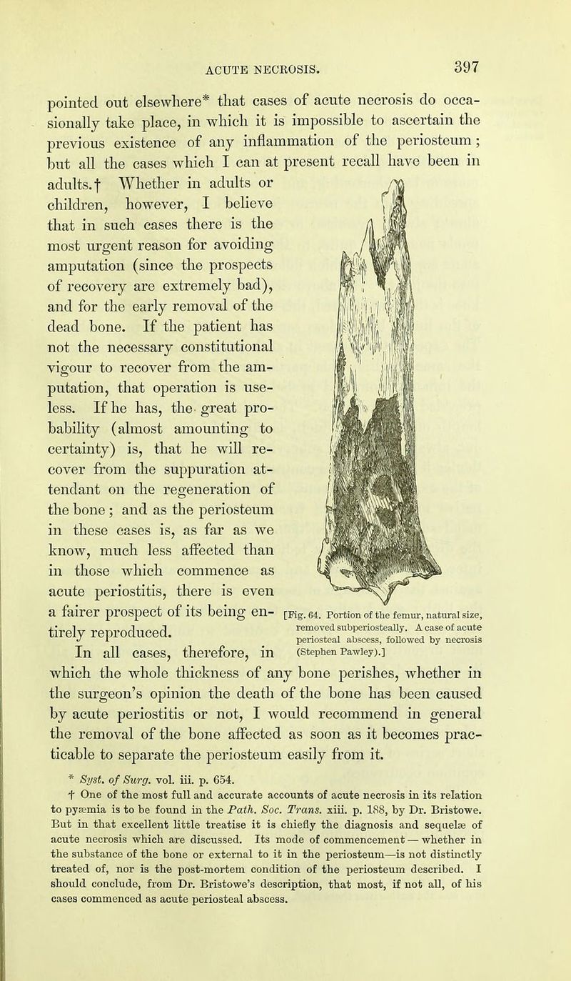pointed out elsewhere* that cases of acute necrosis do occa- sionally take place, in which it is impossible to ascertain the previous existence of any inflammation of the periosteum ; but all the cases which I can at present recall have been in adults, t Whether in adults or children, however, I believe that in such cases there is the most urgent reason for avoiding amputation (since the prospects of recovery are extremely bad), and for the early removal of the dead bone. If the patient has not the necessary constitutional vigour to recover from the am- putation, that operation is use- less. If he has, the great pro- bability (almost amounting to certainty) is, that he will re- cover from the suppuration at- tendant on the regeneration of the bone ; and as the periosteum in these cases is, as far as we know, much less affected than in those which commence as acute periostitis, there is even a fairer prospect of its being en- [Mg. 64. Portion of the femur, natural size, tirely reproduced. removted a case of acute J i periosteal abscess, followed by necrosis In all cases, therefore, in (Stephen Pawiey).] which the whole thickness of any bone perishes, whether in the surgeon's opinion the death of the bone has been caused by acute periostitis or not, I would recommend in general the removal of the bone affected as soon as it becomes prac- ticable to separate the periosteum easily from it. * Syst. of Surg. vol. iii. p. 654. f One of the most full and accurate accounts of acute necrosis in its relation to pyaemia is to be found in the Path. Soc. Trans, xiii. p. 188, by Dr. Bristowe. But in that excellent little treatise it is chiefly the diagnosis and sequelae of acute necrosis which are discussed. Its mode of commencement — whether in the substance of the bone or external to it in the periosteum—is not distinctly treated of, nor is the post-mortem condition of the periosteum described. I should conclude, from Dr. Bristowe's description, that most, if not all, of his cases commenced as acute periosteal abscess.