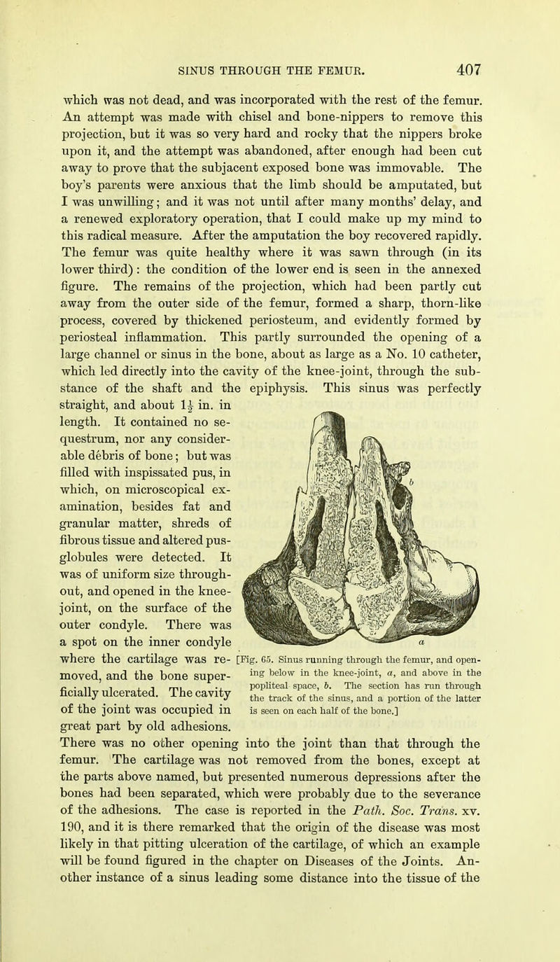 which was not dead, and was incorporated with the rest of the femur. An attempt was made with chisel and bone-nippers to remove this projection, but it was so very hard and rocky that the nippers broke upon it, and the attempt was abandoned, after enough had been cut away to prove that the subjacent exposed bone was immovable. The boy's parents were anxious that the limb should be amputated, but I was unwilling; and it was not until after many months' delay, and a renewed exploratory operation, that I could make up my mind to this radical measure. After the amputation the boy recovered rapidly. The femur was quite healthy where it was sawn through (in its lower third) : the condition of the lower end is seen in the annexed figure. The remains of the projection, which had been partly cut away from the outer side of the femur, formed a sharp, thorn-like process, covered by thickened periosteum, and evidently formed by periosteal inflammation. This partly surrounded the opening of a large channel or sinus in the bone, about as large as a No. 10 catheter, which led directly into the cavity of the knee-joint, through the sub- stance of the shaft and the epiphysis. This sinus was perfectly straight, and about 1£ in. in length. It contained no se- questrum, nor any consider- able debris of bone; but was filled with inspissated pus, in which, on microscopical ex- amination, besides fat and granular matter, shreds of fibrous tissue and altered pus- globules were detected. It was of uniform size through- out, and opened in the knee- joint, on the surface of the outer condyle. There was a spot on the inner condyle where the cartilage was re- [Mg. 65. Sinus running through the femur, and open- moved and the bone super- ne'ovv ™ *'le knee-joint, a, and above in the - . . x i mi popliteal space, b. The section has run through ficially ulcerated. The cavity the track of the sinuSj and a porti(m of the latter of the joint was occupied in is seen on each half of the bone.] great part by old adhesions. There was no other opening into the joint than that through the femur. The cartilage was not removed from the bones, except at the parts above named, but presented numerous depressions after the bones had been separated, which were probably due to the severance of the adhesions. The case is reported in the Path. Soc. Trans, xv. 190, and it is there remarked that the origin of the disease was most likely in that pitting ulceration of the cartilage, of which an example will be found figured in the chapter on Diseases of the Joints. An- other instance of a sinus leading some distance into the tissue of the