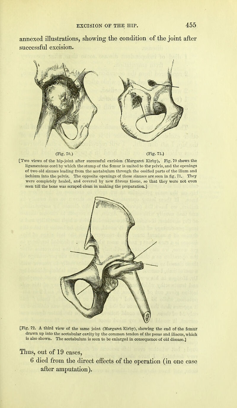 annexed illustrations, showing the condition of the joint after successful excision. (Kg. 70.) (Fig. 71.) [Two views of the hip-joint after successful excision (Margaret Kirby). Fig. 70 shows the ligamentous cord by which the stump of the femur is united to the pelvis, and the openings of two old sinuses leading from the acetabulum through the ossified parts of the ilium and ischium into the pelvis. The opposite openings of these sinuses are seen in fig. 71. They were completely healed, and covered by new fibrous tissue, so that they were not even seen till the bone was scraped clean in making the preparation.] [Fig. 72. A third view of the same joint (Margaret Kirby), showing the end of the femur drawn up into the acetabular cavity by the common tendon of the psoas and iliacus, which is also shown. The acetabulum is seen to be enlarged in consequence of old disease.] Thus, out of 19 cases, 6 died from the direct effects of the operation (in one case after amputation).