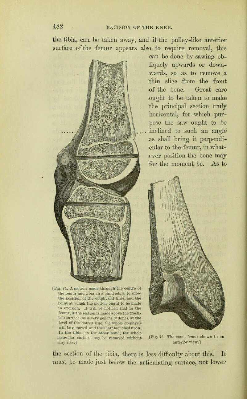 the tibia, can be taken away, and if the pulley-like anterior surface of the femur appears also to require removal, this can be done by sawing ob- liquely upwards or down- wards, so as to remove a thin slice from the front of the bone. Great care ought to be taken to make the principal section truly horizontal, for which pur- pose the saw ought to be inclined to such an angle as shall bring it perpendi- cular to the femur, in what- ever position the bone may for the moment be. As to [Kg. 74. A section made through the centre of the femur and tibia, in a child ret. 5, to show the position of the epiphysial lines, and the point at which the section ought to be made in excision. It will be noticed that in the femur, if the section is made above the troch- lear surface (as is very generally done), at the level of the dotted line, the whole epiphysis will be removed, and the shaft trenched upon. In the tibia, on the other hand, the whole articular surface may be removed without any risk.] [Fig. 75. The same femur shown in an anterior view.] the section of the tibia, there is less difficulty about this. It must bo made just below the articulating surface, not lower