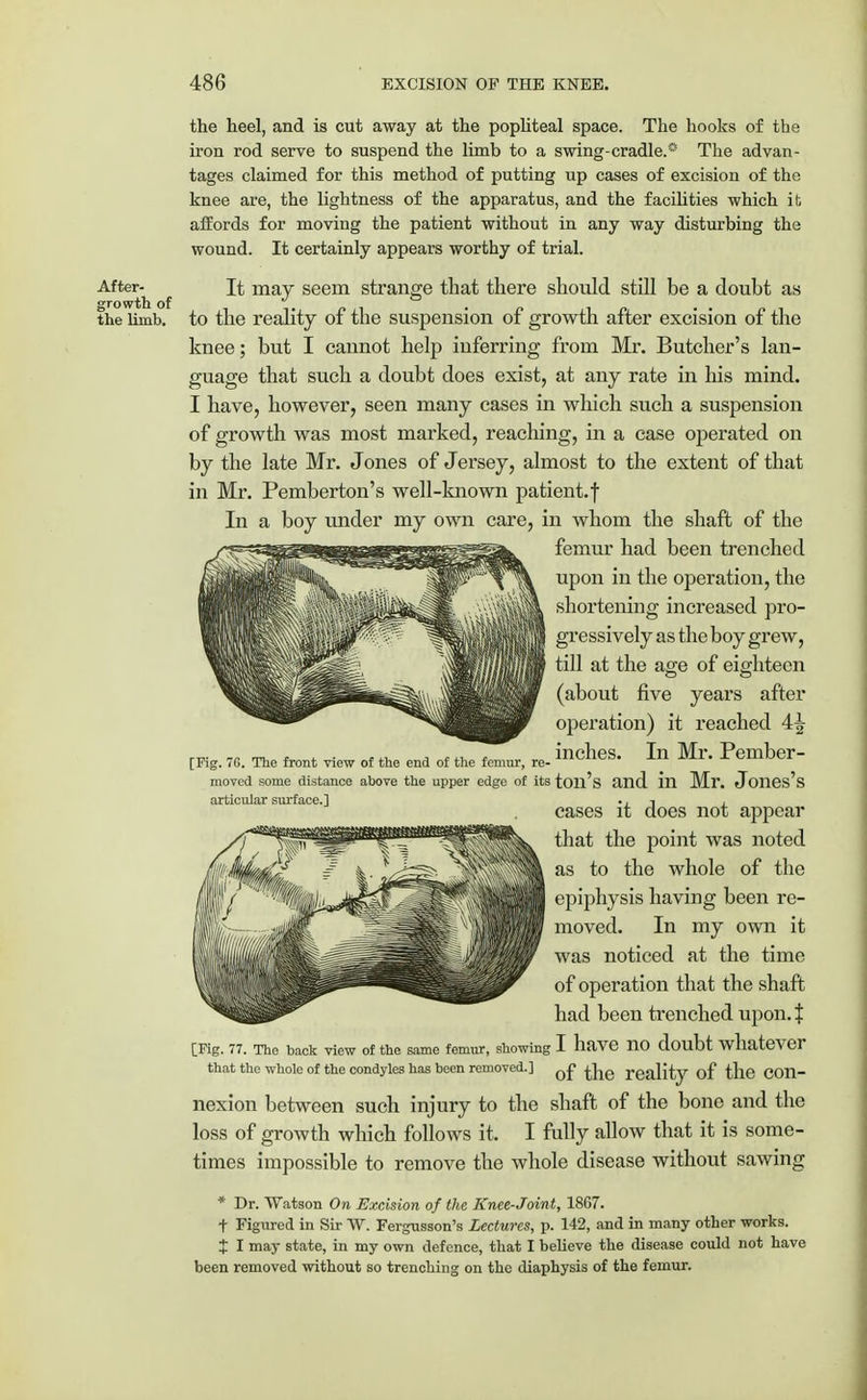 After- growth of the limb. the heel, and is cut away at the popliteal space. The hooks of the iron rod serve to suspend the limb to a swing-cradle.* The advan- tages claimed for this method of putting up cases of excision of the knee are, the lightness of the apparatus, and the facilities which it affords for moving the patient without in any way disturbing the wound. It certainly appears worthy of trial. It may seem strange that there should still be a doubt as to the reality of the suspension of growth after excision of the knee; but I cannot help inferring from Mr. Butcher's lan- guage that such a doubt does exist, at any rate in his mind. I have, however, seen many cases in which such a suspension of growth was most marked, reaching, in a case operated on by the late Mr. Jones of Jersey, almost to the extent of that in Mr. Pemberton's well-known patient.f In a boy under my own care, in whom the shaft of the femur had been trenched upon in the operation, the shortening increased pro- gressively as the boy grew, till at the age of eighteen (about five years after operation) it reached A\ inches. In Mr. Pember- [Fig. 70. The front view of the end of the femur, re- moved some distance above the upper edge of its toil's and ill Mr. Jones's articular surface.] •, i i cases it does not appear that the point was noted as to the whole of the epiphysis having been re- moved. In my own it was noticed at the time of operation that the shaft had been trenched upon. J [Fig. 77. The back view of the same femur, showing I have no doubt whatever that the whole of the condyles has been removed.] Q£ ^e reality of the Con- nexion between such injury to the shaft of the bone and the loss of growth which follows it. I fully allow that it is some- times impossible to remove the whole disease without sawing * Dr. Watson On Excision of the Knee-Joint, 1867. f Figured in Sir W. Fergusson's Lectures, p. 142, and in many other works. t I may state, in my own defence, that I believe the disease could not have been removed without so trenching on the diaphysis of the femur.