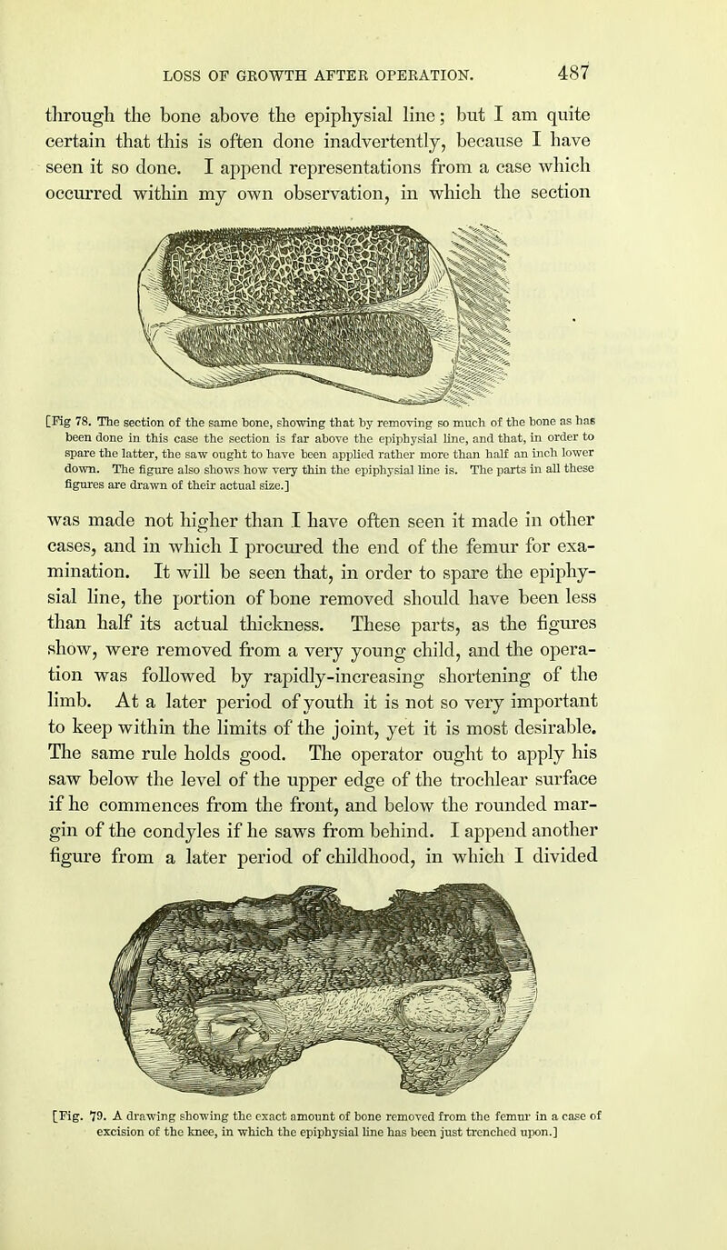 through the bone above the epiphysial line; but I am quite certain that this is often done inadvertently, because I have seen it so done. I append representations from a case which occurred within my own observation, in which the section [Pig 78. The section of the same hone, showing that by removing so much of the bone as has been done in this case the section is far above the epiphysial line, and that, in order to spare the latter, the saw ought to have been applied rather more than half an inch lower down. The figure also shows how very thin the epiphysial line is. The parts in all these figures are drawn of their actual size.] was made not higher than I have often seen it made in other cases, and in which I procured the end of the femur for exa- mination. It will be seen that, in order to spare the epiphy- sial line, the portion of bone removed should have been less than half its actual thickness. These parts, as the figures show, were removed from a very young child, and the opera- tion was followed by rapidly-increasing shortening of the limb. At a later period of youth it is not so very important to keep within the limits of the joint, yet it is most desirable. The same rule holds good. The operator ought to apply his saw below the level of the upper edge of the trochlear surface if he commences from the front, and below the rounded mar- gin of the condyles if he saws from behind. I append another figure from a later period of childhood, in which I divided [Fig. 19. A drawing showing the exact amount of bone removed from the femur in a case of excision of the knee, in which the epiphysial line has been just trenched upon.]