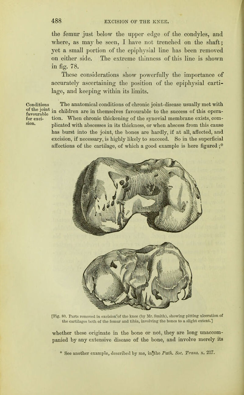 the femur just below the upper edge of the condyles, and where, as may be seen, I have not trenched on the shaft; yet a small portion of the epiphysial line has been removed on either side. The extreme thinness of tins line is shown in fig. 78. These considerations show powerfully the importance of accurately ascertaining the position of the epiphysial carti- lage, and keeping within its limits. Conditions The anatomical conditions of chronic joint-disease usually met with ityourable *Q cn^<^ren are iQ themselves favourable to the success of this opera- tion. When chronic thickening of the synovial membrane exists, com- plicated with abscesses in its thickness, or when abscess from this cause has burst into the joint, the bones are hardly, if at all, affected, and excision, if necessary, is highly likely to succeed. So in the superficial affections of the cartilage, of which a good example is here figured ;° for exci- sion. [Pig. 8ft. Parts removed in excision'of the knee (by Mr. Smith), showing pitting liberation of the cartilages both of the femur and tibia, involving the bones to a slight extent.] whether these originate in the bone or not, they are long unaccom- panied by any extensive disease of the bone, and involve merely its * See another example, described by me, in^the Path. Soc. Trans, x. 217.