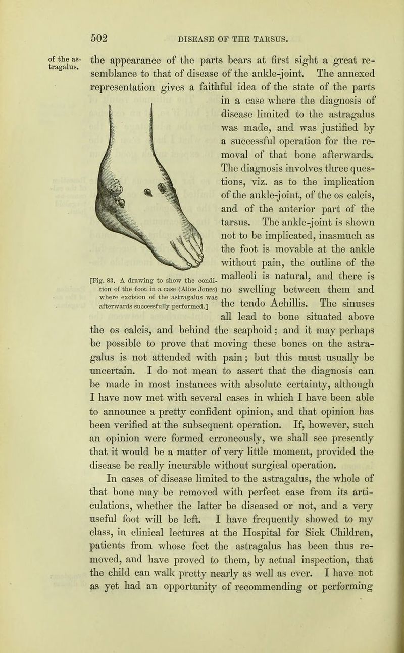 of the as- the appearance of the parts bears at first sight a great re- semblance to that of disease of the ankle-joint. The annexed representation gives a faithful idea of the state of the parts in a case where the diagnosis of disease limited to the astragalus was made, and was justified by a successful operation for the re- moval of that bone afterwards. The diagnosis involves three ques- tions, viz. as to the implication of the ankle-joint, of the os calcis, and of the anterior part of the tarsus. The ankle-joint is shown not to be implicated, inasmuch as the foot is movable at the ankle without pain, the outline of the [Kg. 83. a drawing to show the condi- malleoli is natural, and there is won of the foot m a case (Alice Jones) no swelling between them and where excision of the astragalus was , , . , .... m. afterwards successfully performed.] the tendo AchllllS. llie SUlUSeS all lead to bone situated above the os calcis, and behind the scaphoid: and it may perhaps be possible to prove that moving these bones on the astra- galus is not attended with pain; but this must usually be uncertain. I do not mean to assert that the diagnosis can be made in most instances with absolute certainty, although I have now met with several cases in which I have been able to announce a pretty confident opinion, and that opinion has been verified at the subsequent operation. If, however, such an opinion were formed erroneously, we shall see presently that it would be a matter of very little moment, provided the disease be really incurable without surgical operation. In cases of disease limited to the astragalus, the whole of that bone may be removed with perfect ease from its arti- culations, whether the latter be diseased or not, and a very useful foot will be left. I have frequently showed to my class, in clinical lectures at the Hospital for Sick Children, patients from whose feet the astragalus has been thus re- moved, and have proved to them, by actual inspection, that the child can walk pretty nearly as well as ever. I have not as yet had an opportunity of recommending or performing