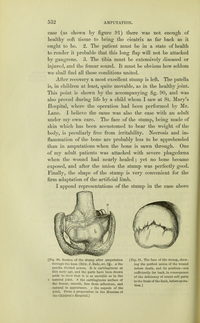 case (as shown by figure 91) there was not enough of healthy soft tissue to bring the cicatrix as far back as it ought to be. 2. The patient must be in a state of health to render it probable that this long flap will not be attacked by gangrene. 3. The tibia must be extensively diseased or injured, and the femur sound. It must be obvious how seldom we shall find all these conditions united. After recovery a most excellent stump is left. The patella is, in children at least, quite movable, as in the healthy joint. This point is shown by the accompanying fig. 90, and was also proved during life by a child whom I saw at St. Mary's Hospital, where the operation had been performed by Mr. Lane. I believe the same was also the case with an adult under my own care. The face of the stump, being made of skin which has been accustomed to bear the weight of the body, is peculiarly free from irritability. Necrosis and in- flammation of the bone are probably less to be apprehended than in amputations when the bone is sawn through. One of my adult patients was attacked with severe phagedena when the wound had nearly healed; yet no bone became exposed, and after the union the stump was perfectly good. Finally, the shape of the stump is very convenient for the firm adaptation of the artificial limb. I append representations of the stump in the case above [Pig. 90. Section of the stump after amputation through the knee (Edw. J. Eade, £et. 2J), a the patella divided across. It is cartilaginous at this early age, and the parts have been drawn aside to show that it is as movable as in the I natural joint. 6 the cartilaginous surface of the femur, smooth, free from adhesions, and natural in appearance, c the capsule of the joint. From a preparation in the Museum of the Children's Hospital.] [Fig. 91. The face of the stump, show- ing the perfect union of the wound before death, and its position—not sufficiently far back, in consequence of the deficiency of sound soft parts in the front of the limb, before opera- tion.]