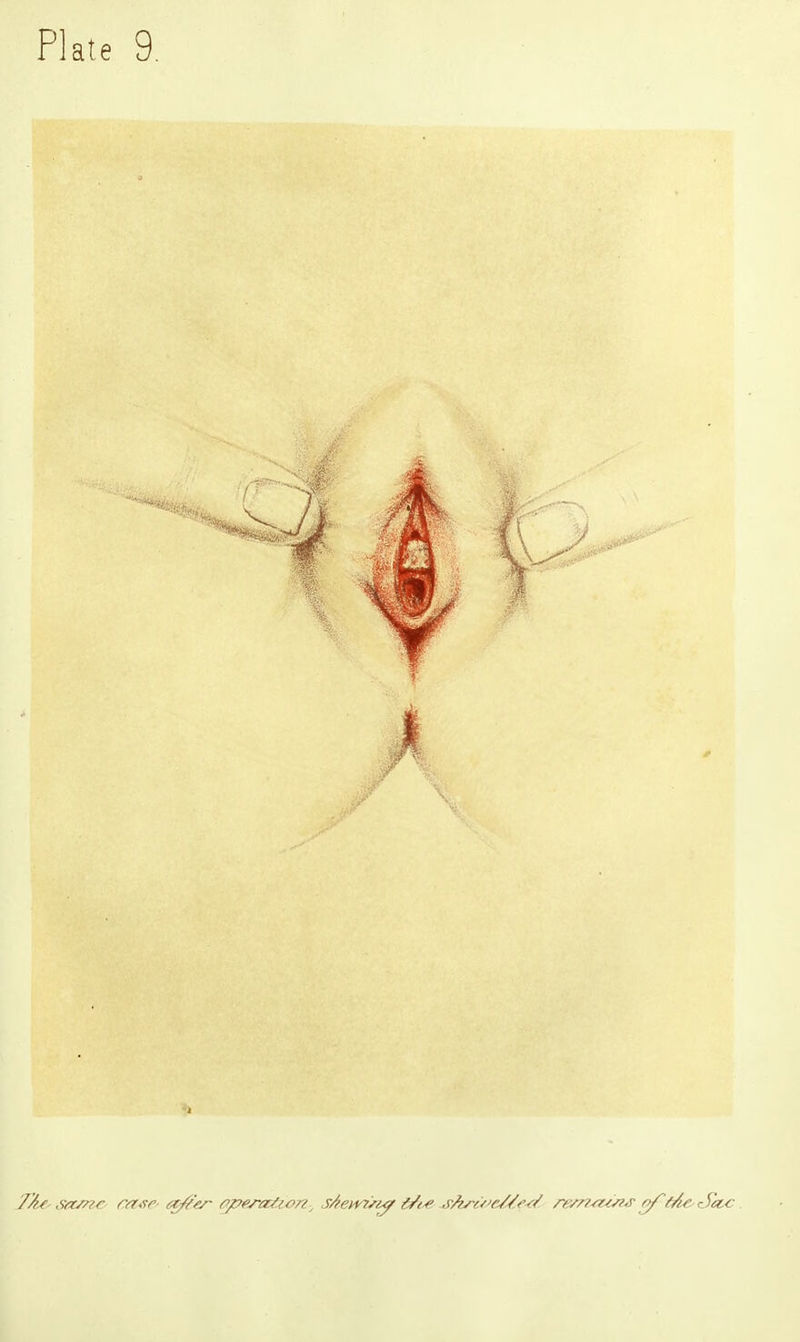 7At- stzsnr case a///zr operation, sfevri/MF i/t^e s/is-t/'c/ZtW 7&n&cn& f&e. rSa.<: