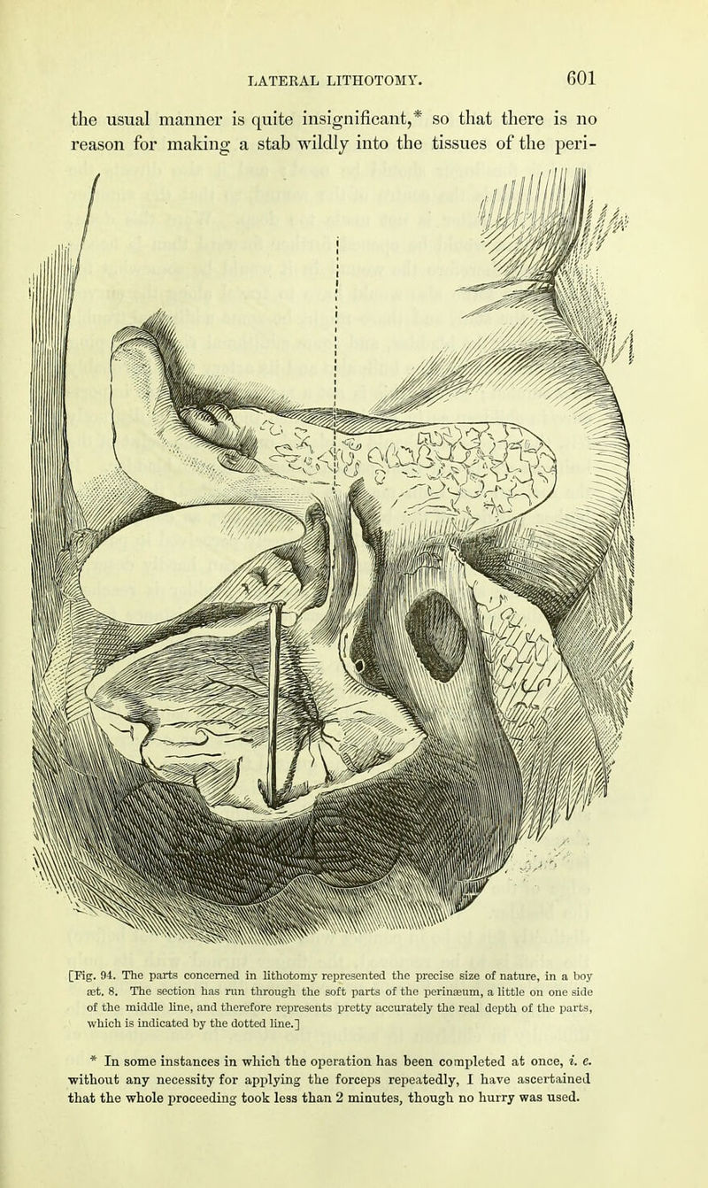 the usual manner is quite insignificant,* so that there is no reason for making a stab wildly into the tissues of the peri- [Fig. 94. The parts concerned in lithotomy represented the precise size of nature, in a boy art. 8. The section has rim through the soft parts of the perinajum, a little on one side of the middle line, and therefore represents pretty accurately the real depth of the parts, which is indicated by the dotted line.] * In some instances in which the operation has been completed at once, i. e. ■without any necessity for applying the forceps repeatedly, I have ascertained that the whole proceeding took less than 2 minutes, though no hurry was used.