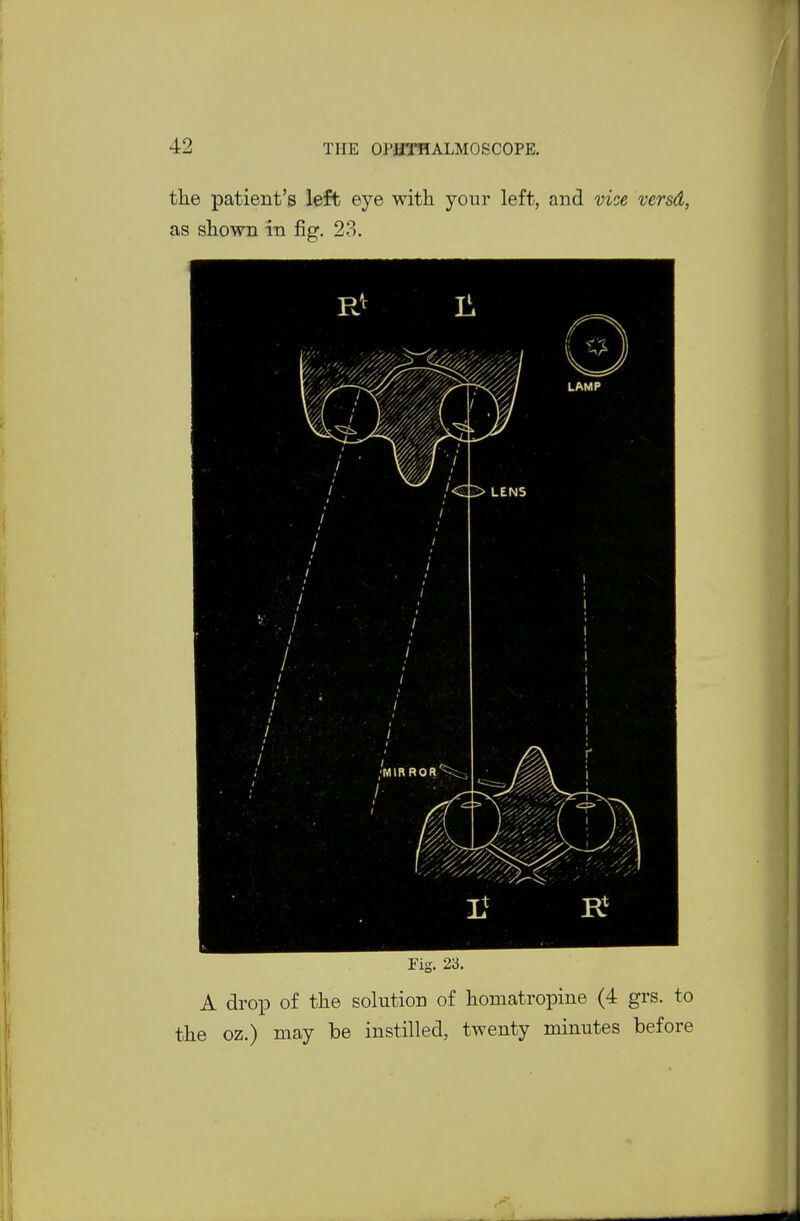 the patient's left eye with your left, and vice versd, as shown in fig. 23. Fig. 23, A drop of the solution of honiatropine (4 grs. to the oz.) may be instilled, twenty minutes before