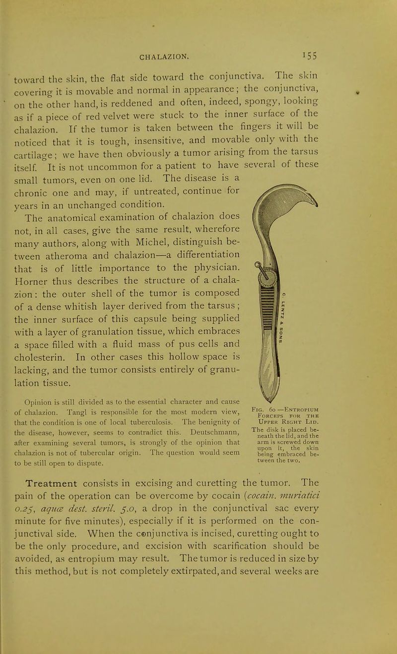 CHALAZION. toward the skin, the flat side toward the conjunctiva. The skin covering it is movable and normal in appearance; the conjunctiva, on the other hand, is reddened and often, indeed, spongy, looking as if a piece of red velvet were stuck to the inner surface of the chalazion. If the tumor is taken between the fingers it will be noticed that it is tough, insensitive, and movable only with the cartilage; we have then obviously a tumor arising from the tarsus itself It is not uncommon for a patient to have several of these small tumors, even on one lid. The disease is a chronic one and may, if untreated, continue for years in an unchanged condition. The anatomical examination of chalazion does not, in all cases, give the same result, wherefore many authors, along with Michel, distinguish be- tween atheroma and chalazion—a differentiation that is of little importance to the physician. Horner thus describes the structure of a chala- zion : the outer shell of the tumor is composed of a dense whitish layer derived from the tarsus ; the inner surface of this capsule being supplied with a layer of granulation tissue, which embraces a space filled with a fluid mass of pus cells and Cholesterin. In other cases this hollow space is lacking, and the tumor consists entirely of granu- lation tissue. Opinion is still divided as to the essential character and cause of chalazion. Tangl is responsible for the most modern view, that the condition is one of local tuberculosis. The benignity of the disease, however, seems to contradict this. Deutschmann, after examining several tumors, is strongly of the opinion that chalazion is not of tubercular origin. The question would seem to be still open to dispute. Fig. 60 —Entropium Forceps for the Upper Right Lid. The disk is placed be- neath the lid, and the arm is screwed down upon it, the skin being embraced be- tween the two. Treatment consists in excising and curetting the tumor. The pain of the operation can be overcome by cocain [cocain. mnriatici 0.2^, aqiice dest. steril. 5.0, a drop in the conjunctival sac every minute for five minutes), especially if it is performed on the con- junctival side. When the ccnjunctiva is incised, curetting ought to be the only procedure, and excision with scarification should be avoided, as entropium may result. The tumor is reduced in size by this method, but is not completely extirpated, and several weeks are