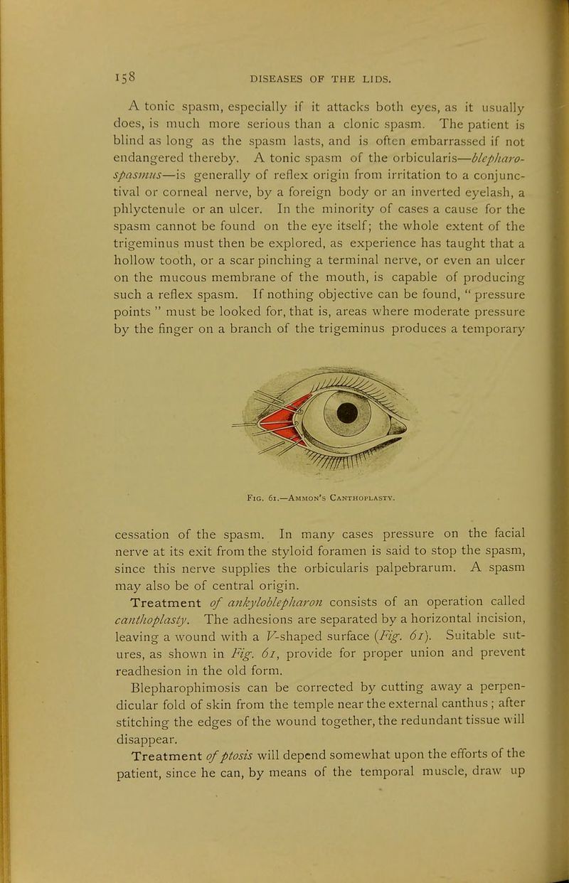 A tonic spasm, especially if it attacks both eyes, as it usually does, is much more serious than a clonic spasm. The patient is blind as long as the spasm lasts, and is often embarrassed if not endangered thereby. A tonic spasm of the orbicularis—blepliaro- spasnms—is generally of reflex origin from irritation to a conjunc- tival or corneal nerve, by a foreign body or an inverted eyelash, a phlyctenule or an ulcer. In the minority of cases a cause for the spasm cannot be found on the eye itself; the whole extent of the trigeminus must then be explored, as experience has taught that a hollow tooth, or a scar pinching a terminal nerve, or even an ulcer on the mucous membrane of the mouth, is capable of producing such a reflex spasm. If nothing objective can be found,  pressure points  must be looked for, that is, areas where moderate pressure by the finger on a branch of the trigeminus produces a temporary Fig. 6i.—Ammon's Canthoplasty. cessation of the spasm. In many cases pressure on the facial nerve at its exit from the styloid foramen is said to stop the spasm, since this nerve supplies the orbicularis palpebrarum. A spasm may also be of central origin. Treatment of ankyloblepJiaron consists of an operation called cantlioplasty. The adhesions are separated by a horizontal incision, leaving a wound with a F-shaped surface {Fig. 6i). Suitable sut- ures, as shown in Fig. 6i, provide for proper union and prevent readhesion in the old form. Blepharophimosis can be corrected by cutting away a perpen- dicular fold of skin from the temple near the external canthus; after stitching the edges of the wound together, the redundant tissue will disappear. Treatment of ptosis will depend somewhat upon the efforts of the patient, since he can, by means of the temporal muscle, draw up