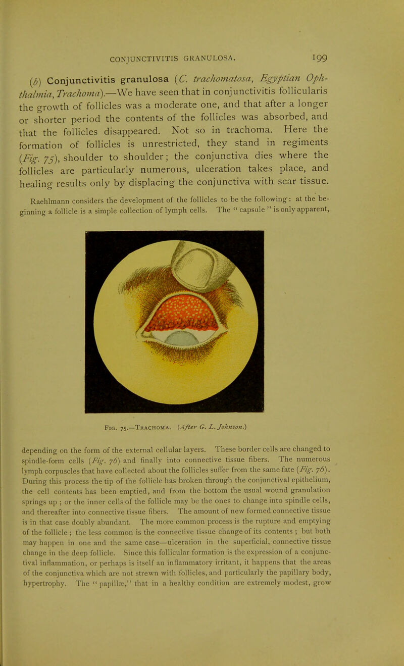{p) Conjunctivitis granulosa [C. tmchomatosa, Egyptian Oph- thalmia, Trachoma).—We have seen that in conjunctivitis foUicularis the growth of follicles was a moderate one, and that after a longer or shorter period the contents of the follicles was absorbed, and that the follicles disappeared. Not so in trachoma. Here the formation of follicles is unrestricted, they stand in regiments (/vV shoulder to shoulder; the conjunctiva dies where the follicles are particularly numerous, ulceration takes place, and healing results only by displacing the conjunctiva with scar tissue. Raehlmann considers the development of the follicles to be the following: at the be- ginning a follicle is a simple collection of lymph cells. The  capsule  is only apparent, Fig. 75.—Trachoma. (After G. L. Johnson.) depending on the form of the external cellular layers. These border cells are changed to spindle-form cells {Fig. 76) and finally into connective tissue fibers. The numerous lymph corpuscles that have collected about the follicles suffer from the same fate {Fig. 76). During this process the tip of the follicle has broken through the conjunctival epithelium, the cell contents has been emptied, and from the bottom the usual wound granulation springs up ; or the inner cells of the follicle may be the ones to change into spindle cells, and thereafter into connective tissue fibers. The amount of new formed connective tissue is in that case doubly abundant. The more common process is the rupture and emptying of the follicle ; the less common is the connective tissue change of its contents ; but both may hajipen in one and the same case—ulceration in the superficial, connective tissue change in the deep follicle. Since this follicular formation is the expression of a conjunc- tival inflammation, or perhaps is itself an inflammatory irritant, it happens that the areas of the conjunctiva which are not strewn with follicles, and particularly the papillary body, hypertrophy. The  papilhv:, that in a healthy condition are extremely modest, grow