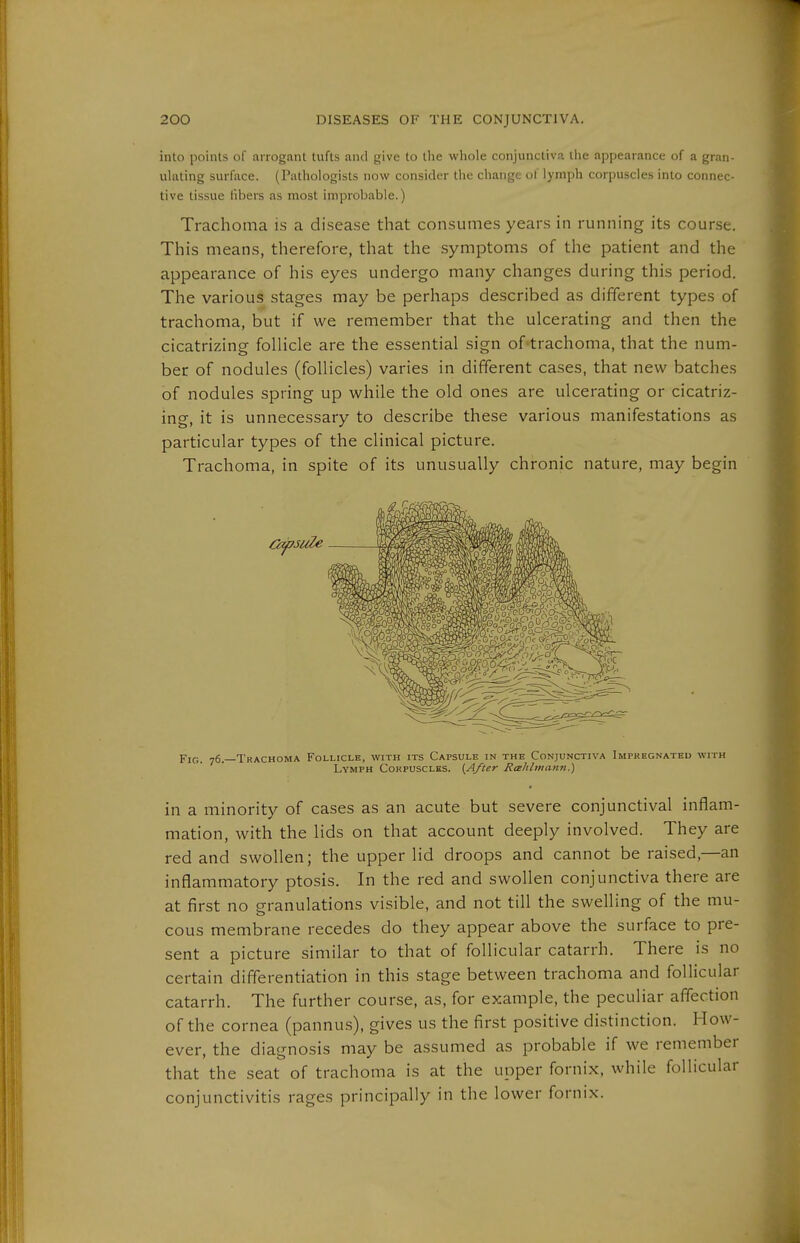 into points of arrogant tufts aiui give to tlie wliole conjunctiva llie appearance of a gran- ulating surface. (Pathologists now consider the change of lymph corpuscles into connec- tive tissue libers as most improbable,) Trachoma is a disease that consumes years in running its course. This means, therefore, that the symptoms of the patient and the appearance of his eyes undergo many changes during this period. The various stages may be perhaps described as different types of trachoma, but if we remember that the ulcerating and then the cicatrizing follicle are the essential sign of-trachoma, that the num- ber of nodules (follicles) varies in different cases, that new batches of nodules spring up while the old ones are ulcerating or cicatriz- ing, it is unnecessary to describe these various manifestations as particular types of the clinical picture. Trachoma, in spite of its unusually chronic nature, may begin Fig. 76.—Trachoma Follicle, with its Capsule in the Conjunctiva Impregnated with Lymph Corpuscles. (After Rahlmann.) in a minority of cases as an acute but severe conjunctival inflam- mation, with the lids on that account deeply involved. They are red and swollen; the upper lid droops and cannot be raised,—an inflammatory ptosis. In the red and swollen conjunctiva there are at first no granulations visible, and not till the swelling of the mu- cous membrane recedes do they appear above the surface to pre- sent a picture similar to that of follicular catarrh. There is no certain differentiation in this stage between trachoma and follicular catarrh. The further course, as, for example, the peculiar affection of the cornea (pannus), gives us the first positive distinction. How- ever, the diagnosis may be assumed as probable if we remember that the seat of trachoma is at the upper fornix, while follicular conjunctivitis rages principally in the lower fornix.