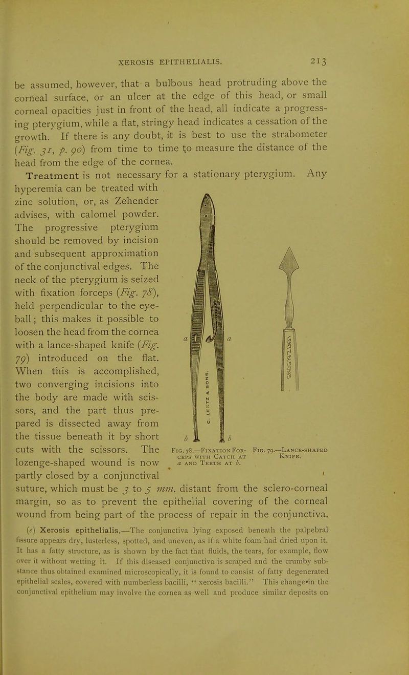 Any be assumed, however, that a bulbous head protruding above the corneal surface, or an ulcer at the edge of this head, or small corneal opacities just in front of the head, all indicate a progress- ing pterygium, while a flat, stringy head indicates a cessation of the growth. If there is any doubt, it is best to use the strabometer ji^ p, go) from time to time 1;o measure the distance of the head from the edge of the cornea. Treatment is not necessary for a stationary pterygium, hyperemia can be treated with zinc solution, or, as Zehender advises, with calomel powder. The progressive pterygium should be removed by incision and subsequent approximation of the conjunctival edges. The neck of the pterygium is seized with fixation forceps {Fig. yS), held perpendicular to the eye- ball ; this makes it possible to loosen the head from the cornea with a lance-shaped knife {Fig. yg) introduced on the flat. When this is accomplished, two converging incisions into the body are made with scis- sors, and the part thus pre- pared is dissected away from the tissue beneath it by short cuts with the scissors. The lozenge-shaped wound is now partly closed by a conjunctival ' suture, which must be j to 5 7nin. distant from the sclero-corneal margin, so as to prevent the epithelial covering of the corneal wound from being part of the process of repair in the conjunctiva. (<?) Xerosis epithelialis.—The conjunctiva lying exposed beneath the palpebral fissure appears dry, lusterless, spotted, and uneven, as if a wliite foam had dried upon it. It has a fatty structure, as is shown by the fact that fluids, the tears, for example, flow over it without wetting it. If this diseased conjunctiva is scraped and the crumby sub- stance thus obtained examined microscopically, it is found to consist of fatty degenerated epithelial scales, covered with numberless bacilli, xerosis bacilli. This change'in the conjunctival epithelium may involve the cornea as well and produce similar deposits on Fig. 78.—Fixation For- Fig. 79.—Lance-shaped CEPS WITH Catch at Knife. a AND Teeth at b.