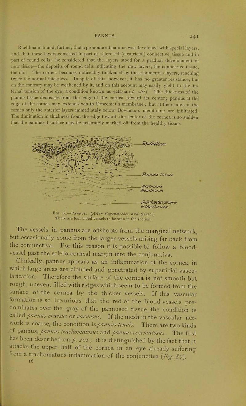 PANNUS. Raehlniann found, fiirtlier, that a pronounced pannus was developed with special layers, and that these layers consisted in part of sclerosed (cicatricial) connective tissue and in part of round cells; he considered that the layers stood for a gradual development of new tissue—the deposits of round cells indicating the new layers, the connective tissue, the old. The cornea becomes noticeably thickened by these numerous layers, reaching twice the normal thickness. In spite of this, however, it has no greater resistance, but on the contrary may be weakened by it, and on this account may easily yield to the in- ternal tension of the eye, a condition known as ectasia (/. 261). The thickness of the pannus tissue decreases from the edge of the cornea toward its center; pannus at the edge of the cornea may extend even to Descemet's membrane; but at the center of the cornea only the anterior layers immediately below Bowman's membrane are infiltrated. The diminution in thickness from the edge toward the center of the cornea is so sudden that the pannused surface may be accurately marked off from the healthy tissue. Pannus tijjue MeTtibrane - Sid>sieuttici propiit. oft^ Cornea. Fig. 86.—Pannus. (After Pagenstecher and Genth.) There are four blood-vessels to be seen in the section. The vessels in pannus are offshoots from the marginal network, but occasionally come from the larger vessels arising far back from the conjunctiva. For this reason it is possible to follow a blood- vessel past the sclero-corneal margin into the conjunctiva. Clinically, pannus appears as an inflammation of the cornea, in which large areas are clouded and penetrated by superficial vascu- larization. Therefore the surface of the cornea is not smooth but rough, uneven, filled with ridges which seem to be formed from the surface of the cornea by the thicker vessels. If this vascular formation is so luxurious that the red of the blood-vessels pre- dominates over the gray of the pannused tissue, the condition is called pannus crassiis or carnosus. If the mesh in the vascular net- work is coarse, the condition isparmus tenuis. There are two kinds of Y>^nnus, panittcs trachojnatosus and pannus eczematosus. The first has been described on p. 201; it is distinguished by the fact that it attacks the upper half of the cornea in an eye already suffering from a trachomatous inflammation of the conjunctiva {Fig. Sy).