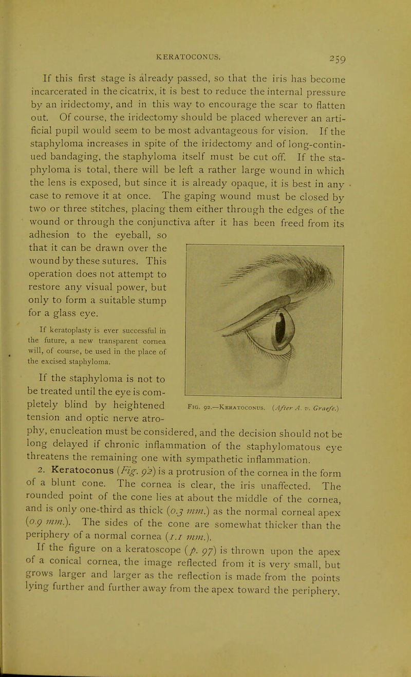 KERATOCONUS. If this first stage is already passed, so that the iris has become incarcerated in the cicatrix, it is best to reduce the internal pressure by an iridectomy, and in this way to encourage the scar to flatten out. Of course, the iridectomy should be placed wherever an arti- ficial pupil would seem to be most advantageous for vision. If the staphyloma increases in spite of the iridectomy and of long-contin- ued bandaging, the staphyloma itself must be cut off. If the sta- phyloma is total, there will be left a rather large wound in which the lens is exposed, but since it is already opaque, it is best in any case to remove it at once. The gaping wound must be closed by two or three stitches, placing them either through the edges of the wound or through the conjunctiva after it has been freed from its adhesion to the eyeball, so that it can be drawn over the wound by these sutures. This operation does not attempt to restore any visual power, but only to form a suitable stump for a glass eye. If keratoplasty is ever successful in the future, a new transparent cornea will, of course, be used in the place of the excised staphyloma. If the Staphyloma is not to be treated until the eye is com- pletely blind by heightened Fig. 92.-keratoconus. (Ayter a.crae/e.) tension and optic nerve atro- phy, enucleation must be considered, and the decision should not be long delayed if chronic inflammation of the staphylomatous eye threatens the remaining one with sympathetic inflammation. 2. Keratoconus {Fi^. p>) is a protrusion of the cornea in the form of a blunt cone. The cornea is clear, the iris unaffected. The rounded point of the cone lies at about the middle of the cornea, and is only one-third as thick (o.j mm) as the normal corneal apex (o.p mm). The sides of the cone are somewhat thicker than the periphery of a normal cornea (/.z vim). If the figure on a keratoscope (/. gf) is thrown upon the apex of a conical cornea, the image reflected from it is very small, but grows larger and larger as the reflection is made from the points lymg further and further away from the apex toward the periphery.